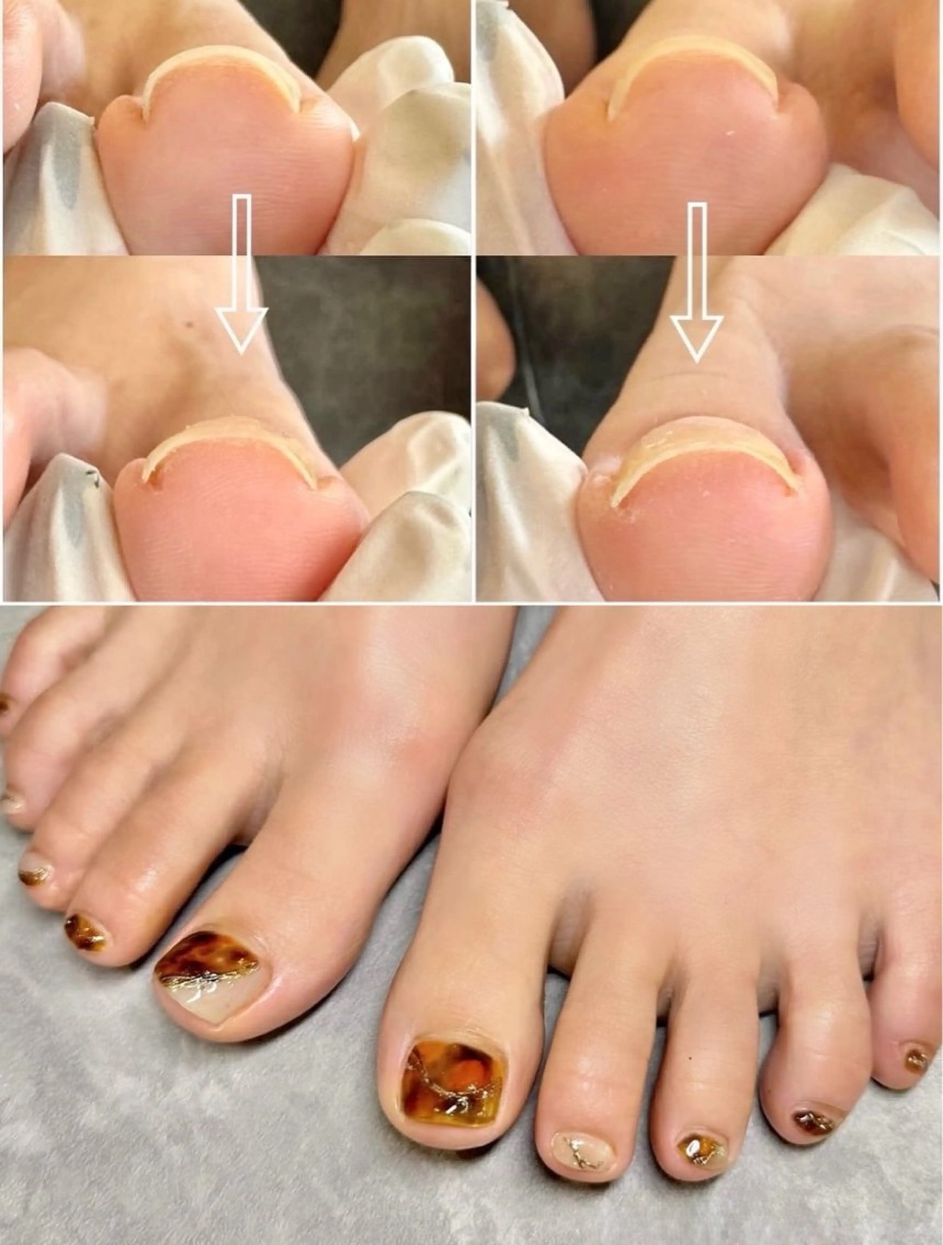 期間限定☀️巻き爪矯正初めての方【1本¥4500➡︎¥2000〜3000】+デザイン (合計¥13000〜15000)の写真