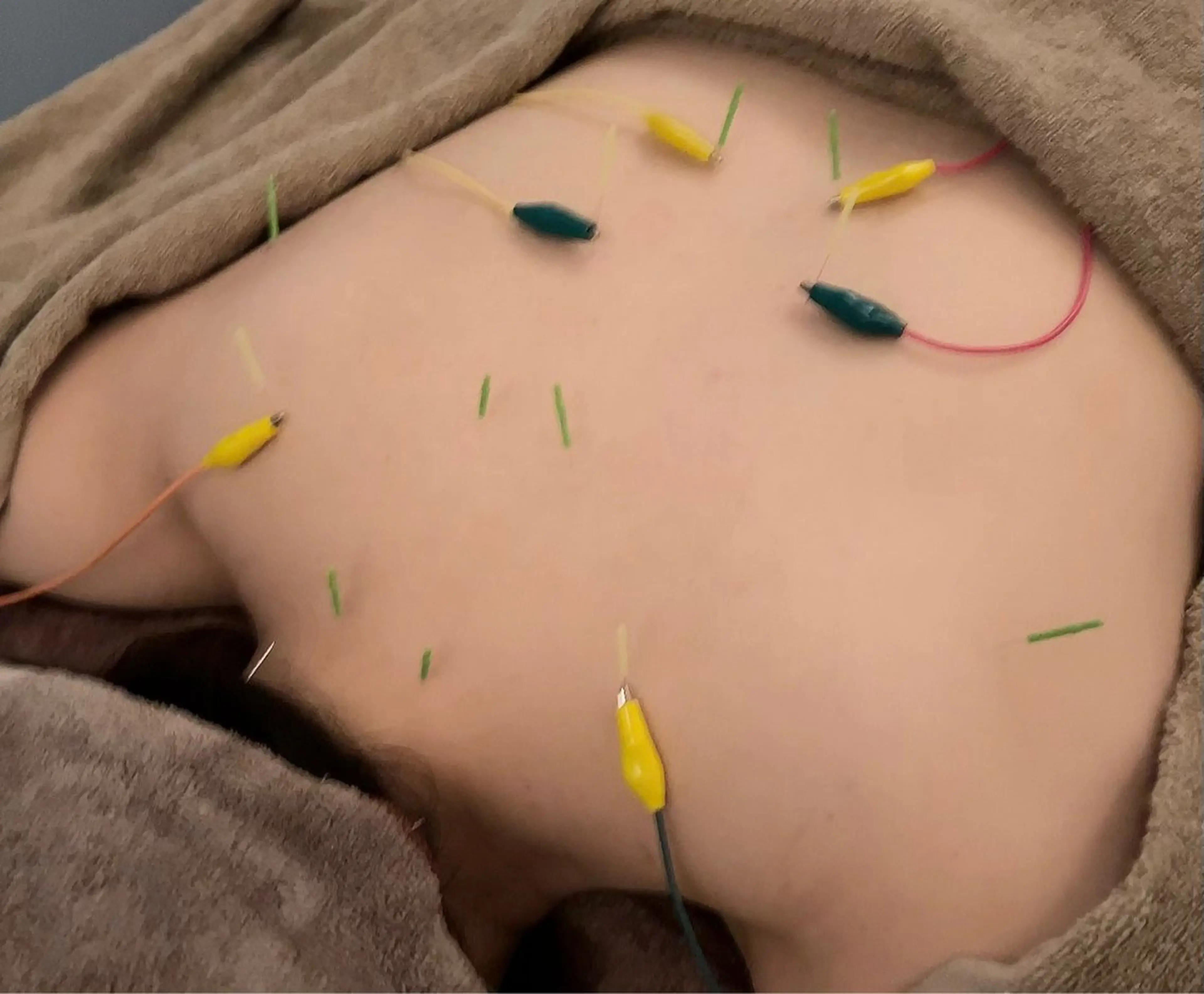 【経絡小顔美容鍼 90分】全身×小顔電気鍼+ラジオ波or顔筋リフト+筋膜ほぐし/ヒト幹整肌/ヘッド・首肩マッサージの写真