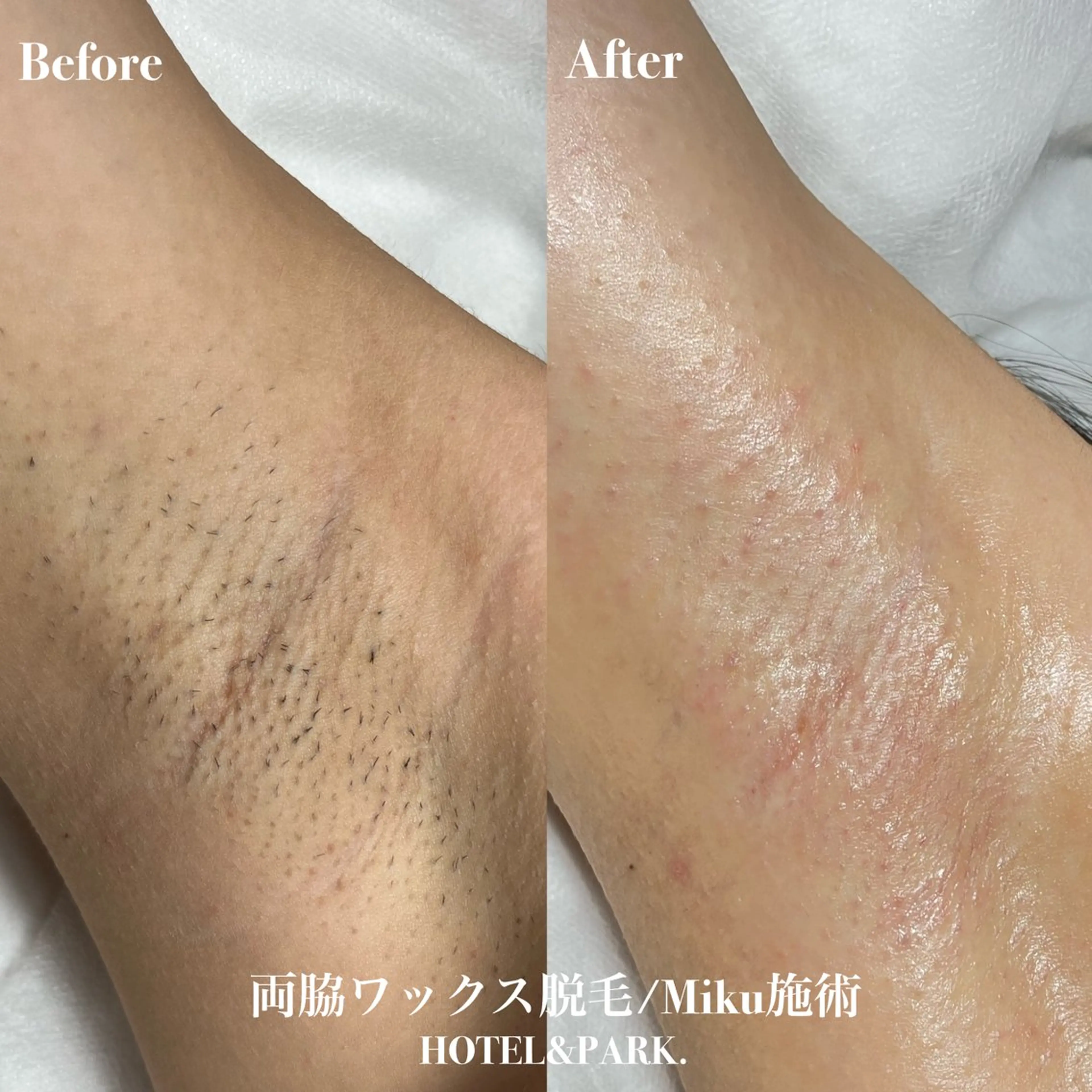 脱毛 HOTEL&PARK Mikuワックス脱毛のエステ・リラクイメージ