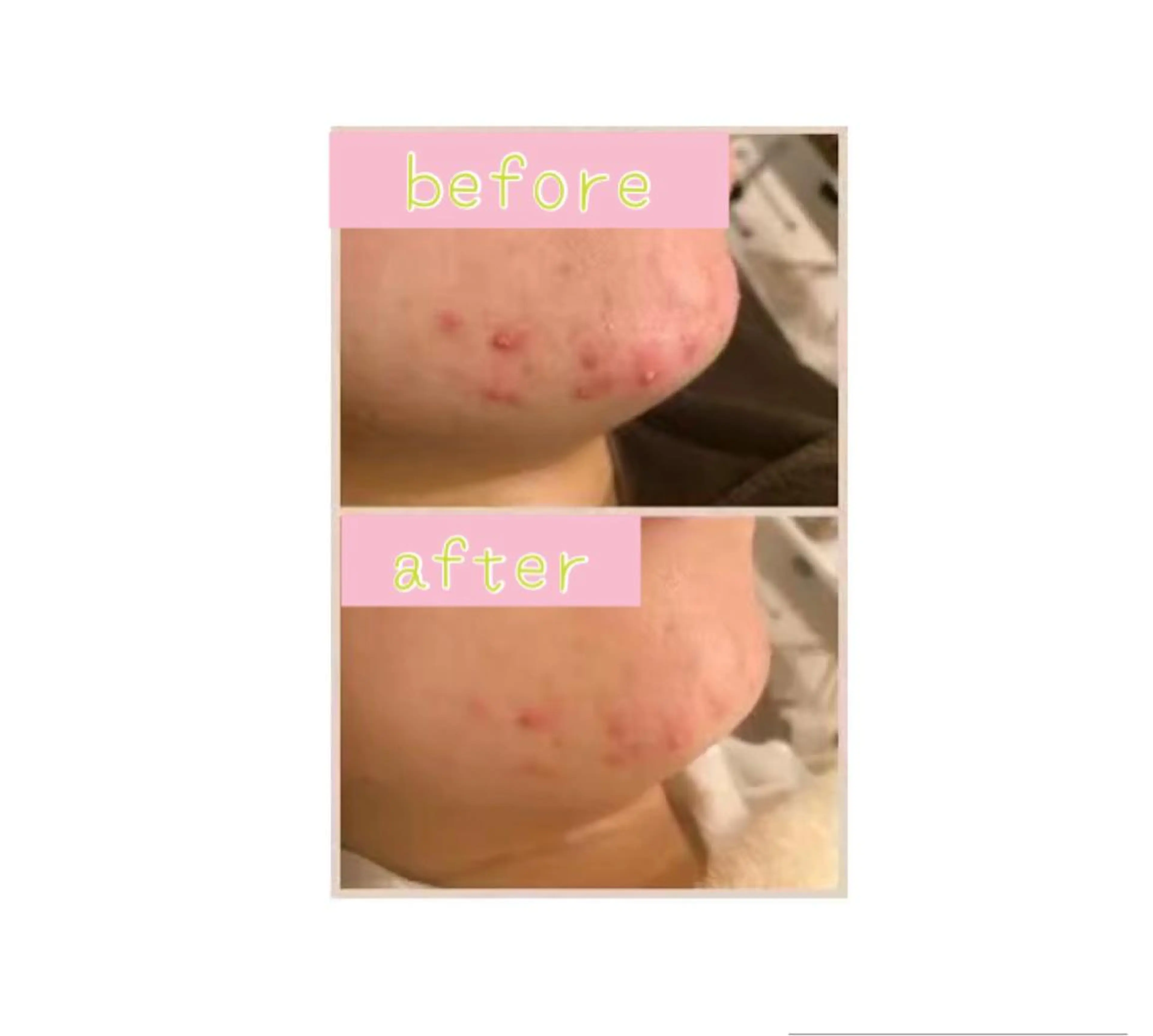 《スペシャルフェイシャル90分15000円》❣️温泉由来の蜜蝋パック♨️ ほぐしと小顔矯正付き❣️の写真