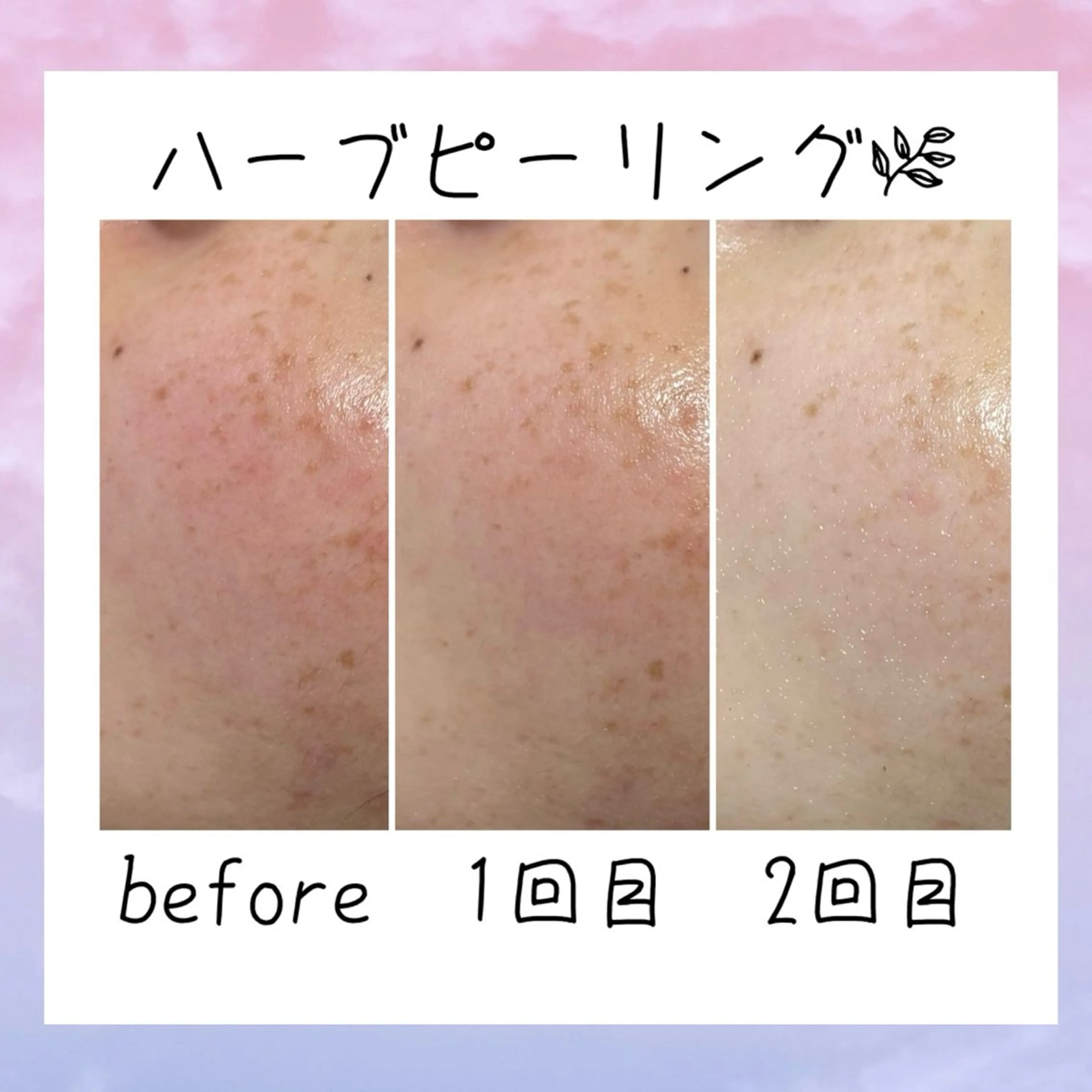 メンズ メンズ韓国風 ニキビ 毛穴ケア シャルム ココ みさのエステ・リラクイメージ