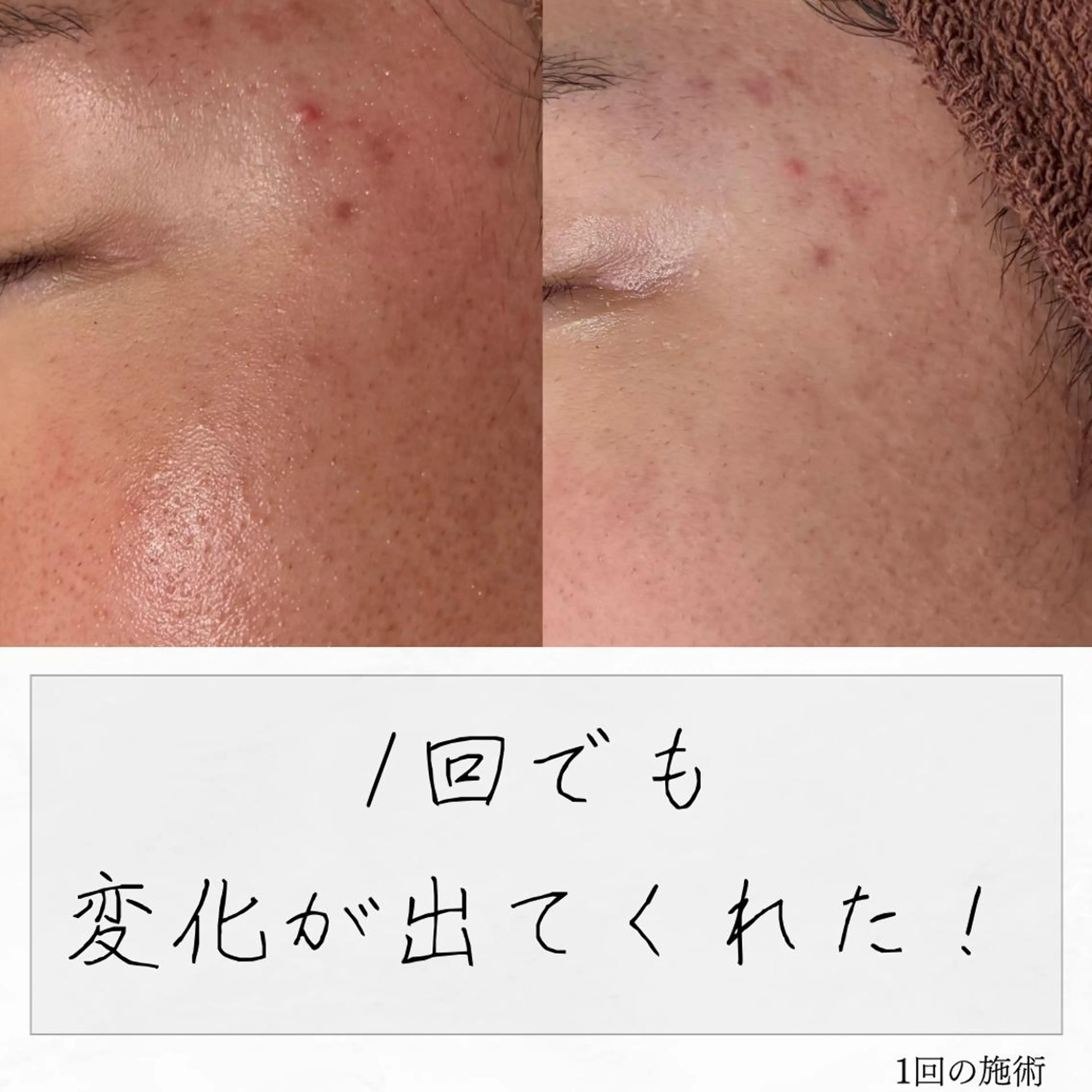 ニキビ経験者が施術 する専門サロン🌻のエステ・リラクイメージ