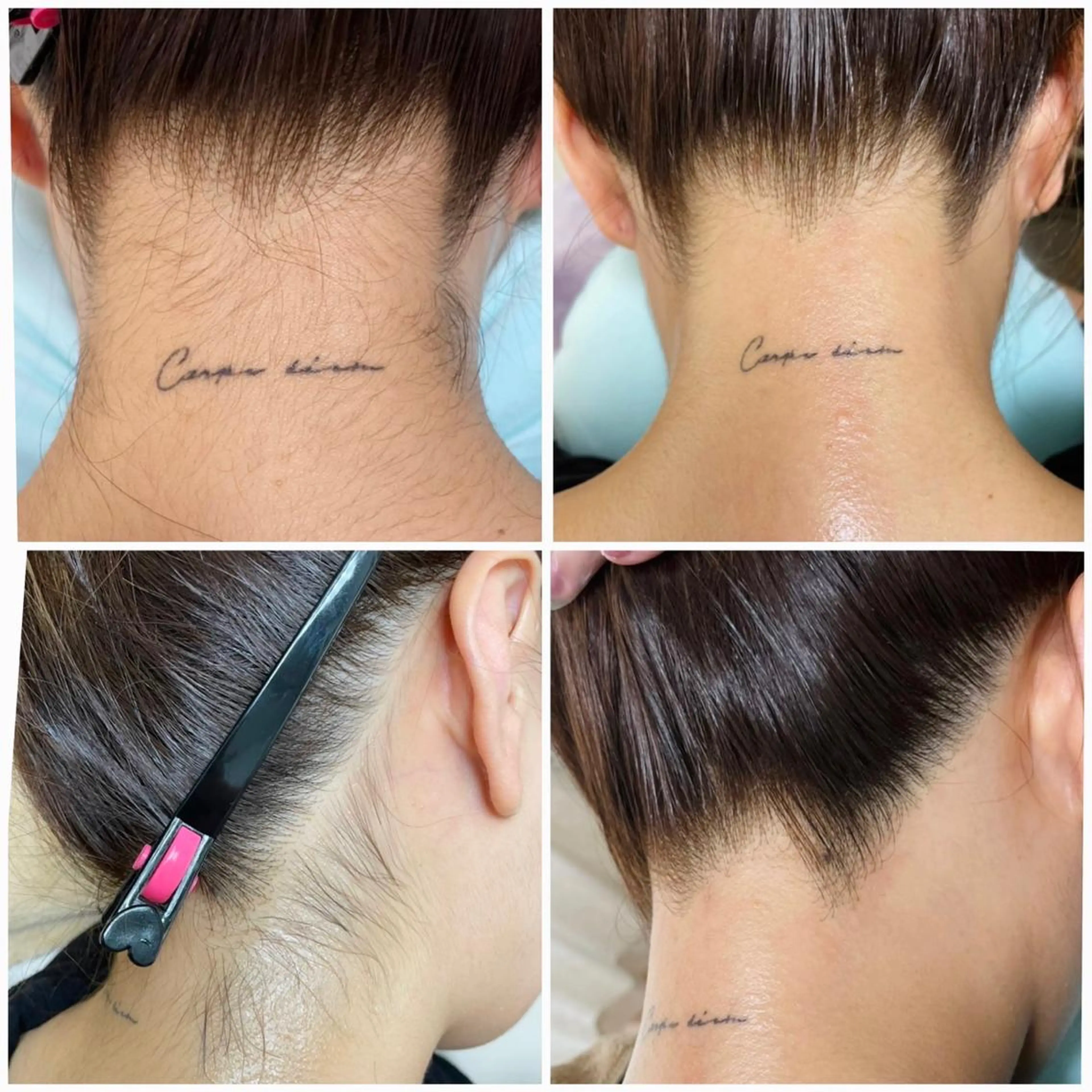 うなじ WAX脱毛 ✖️光脱毛👱🏻‍♀️うなじ綺麗にします💓（ワックスのみは¥4400）の写真