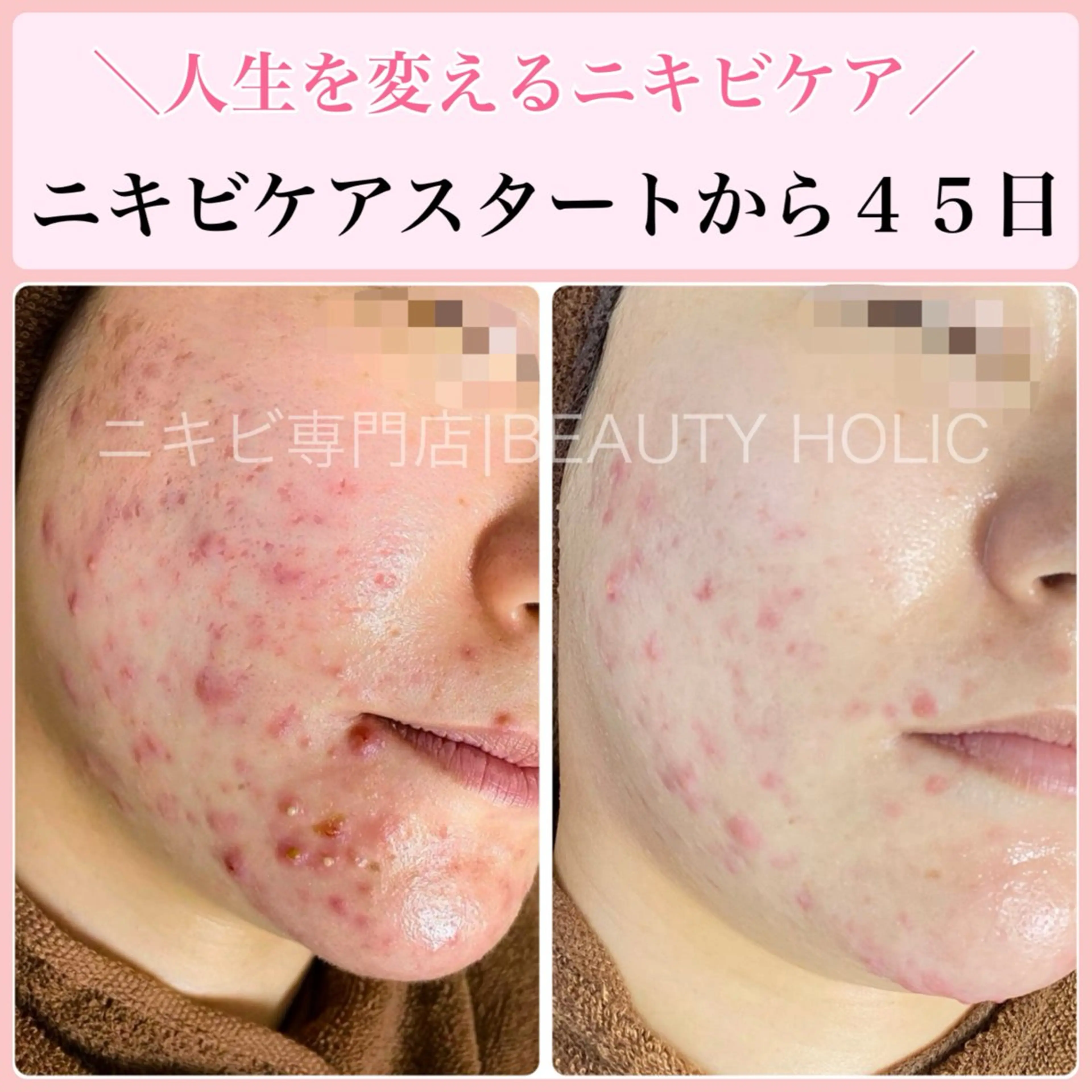 エステ リラク ニキビ・ 肌荒れ専門店のエステ・リラクイメージ