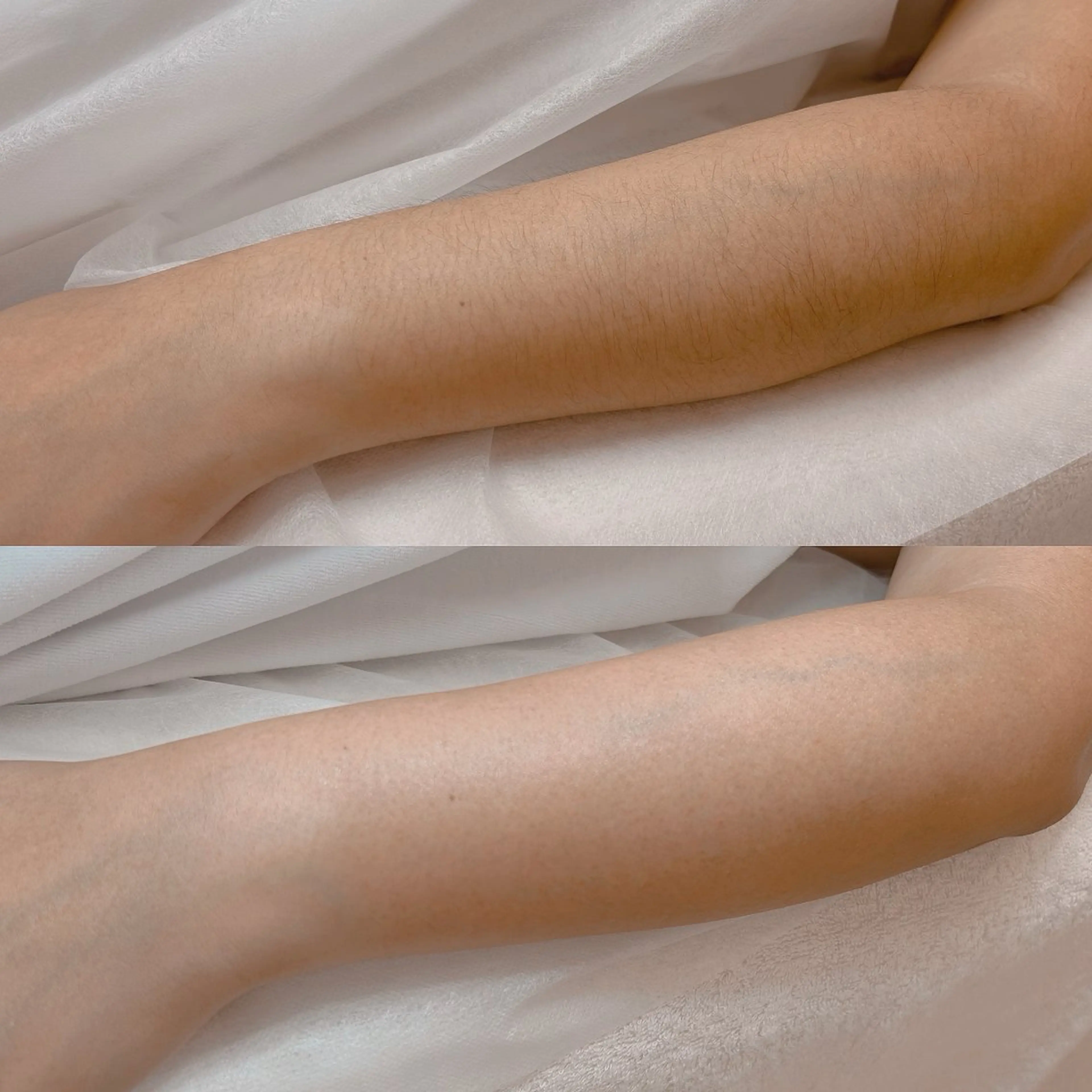 【ワックス脱毛-Lパーツ】の写真