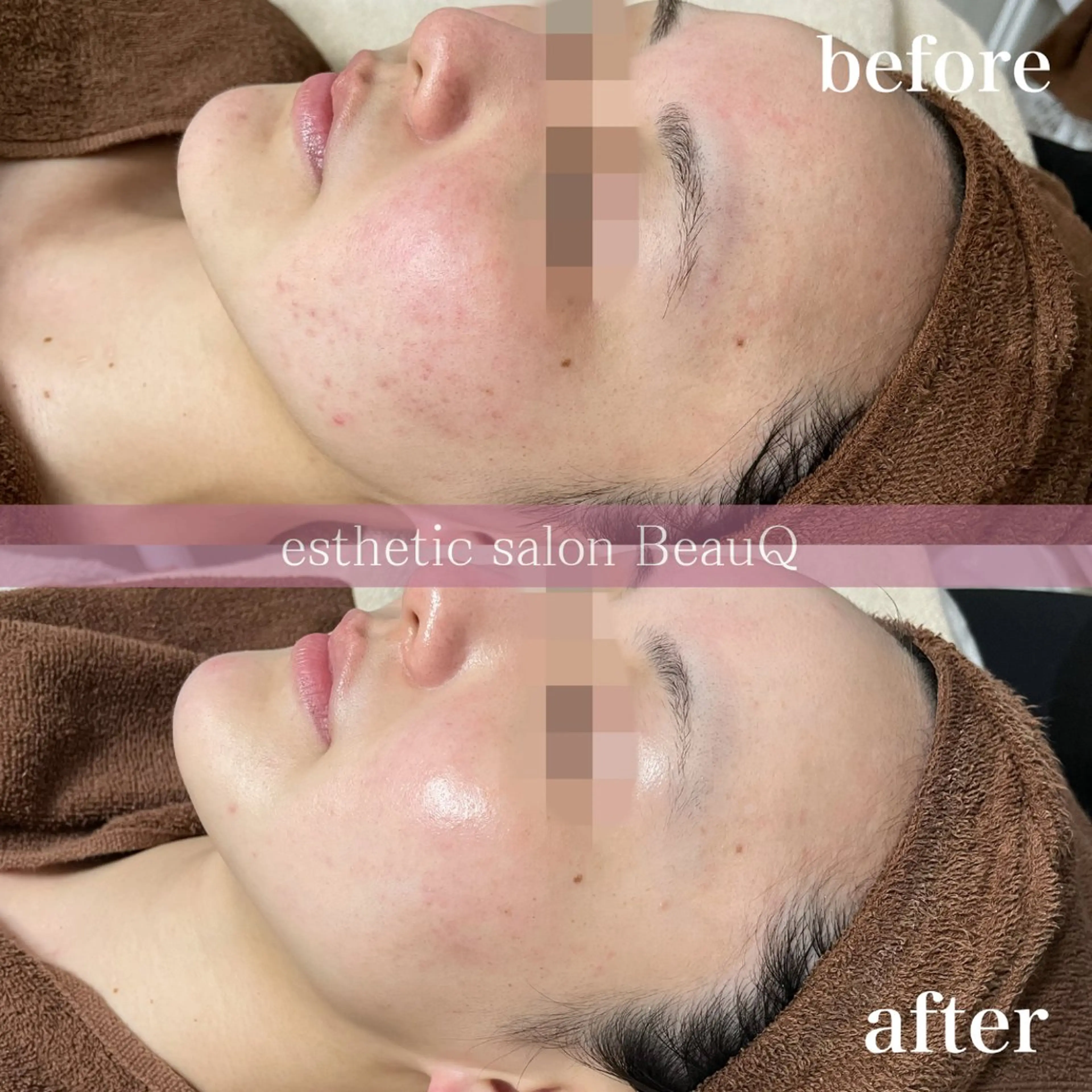 肌質改善/ブライダル 水上百華のエステ・リラクイメージ