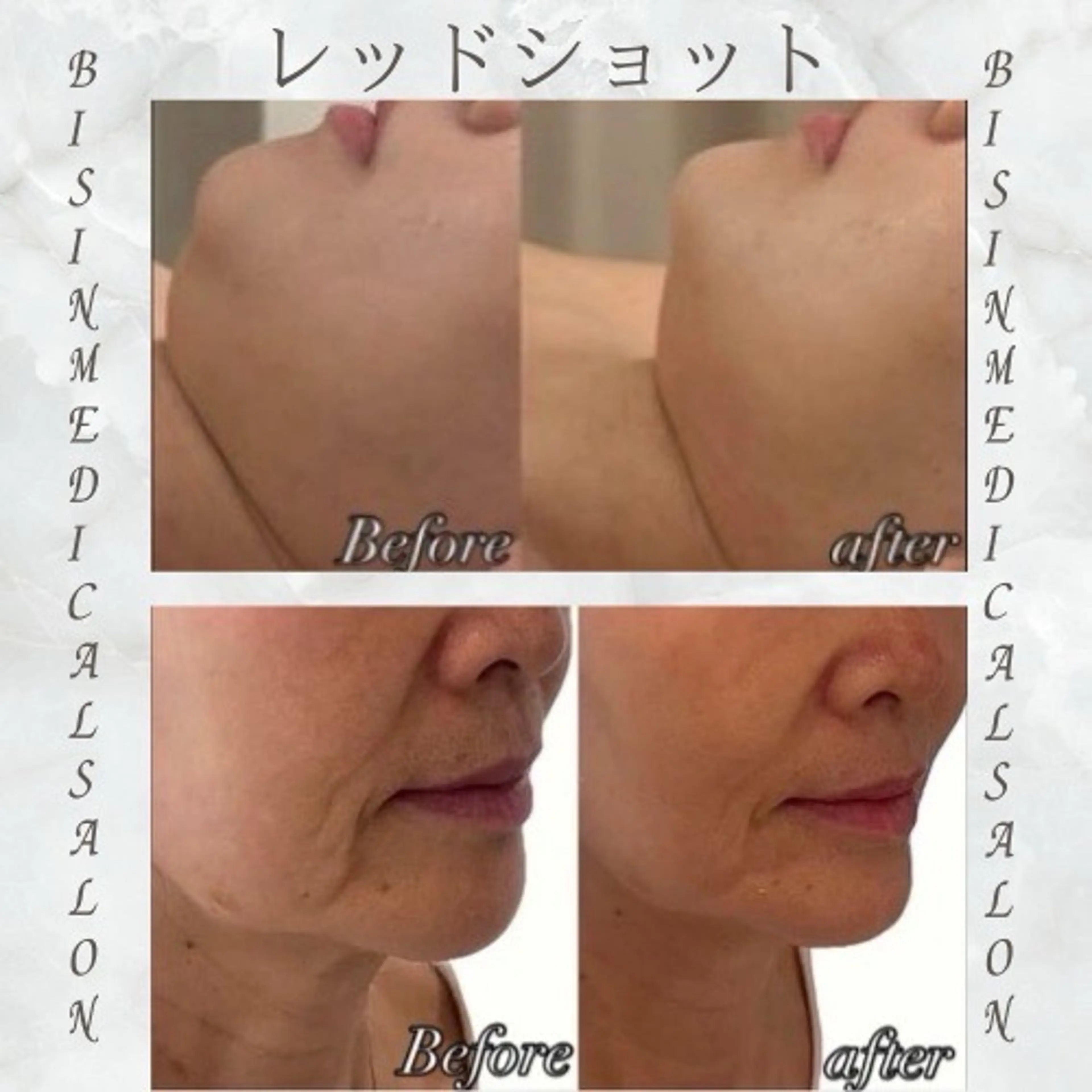 最先端‼️レッドショット1cc‼️✨の写真