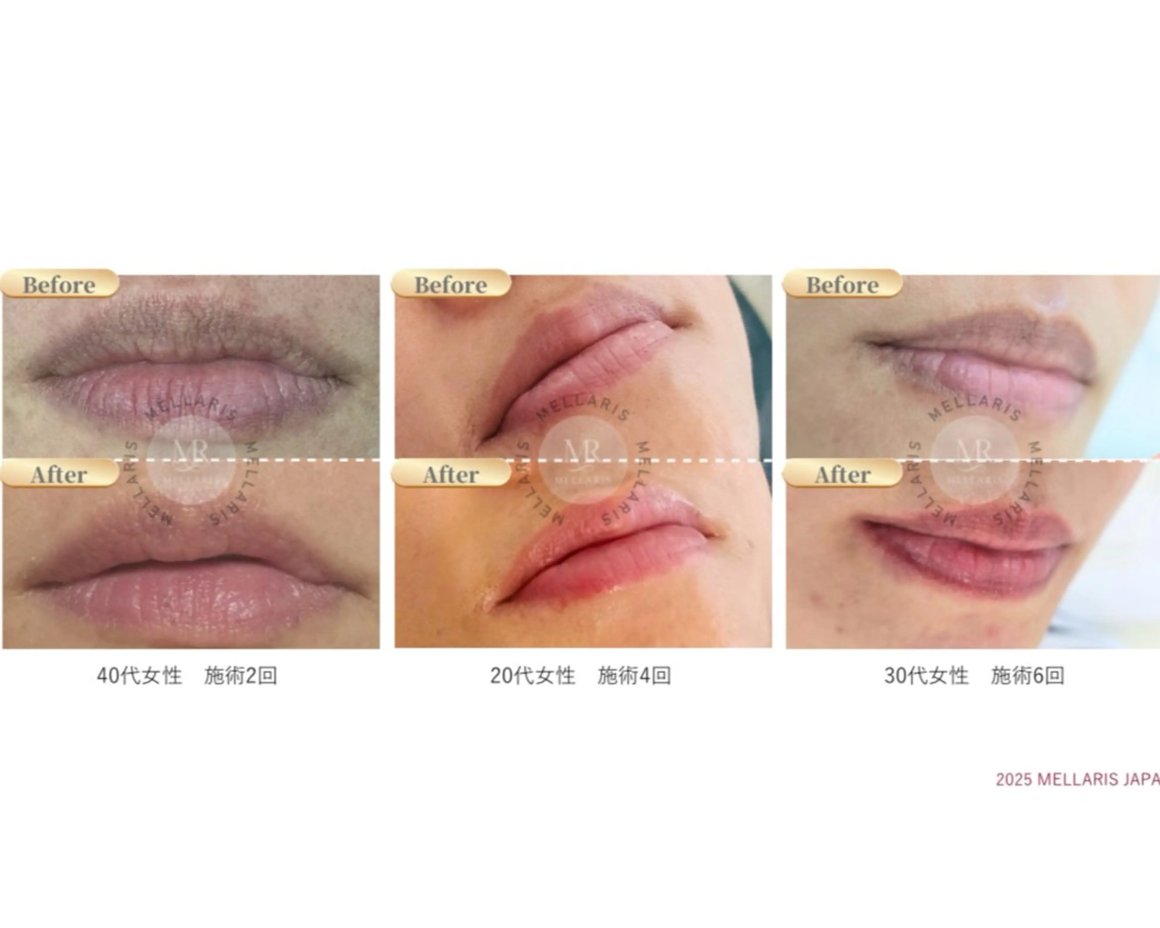 【モニター限定価格】メラリス新メラニンケア"唇リップ"💋アフタークリーム付きの写真