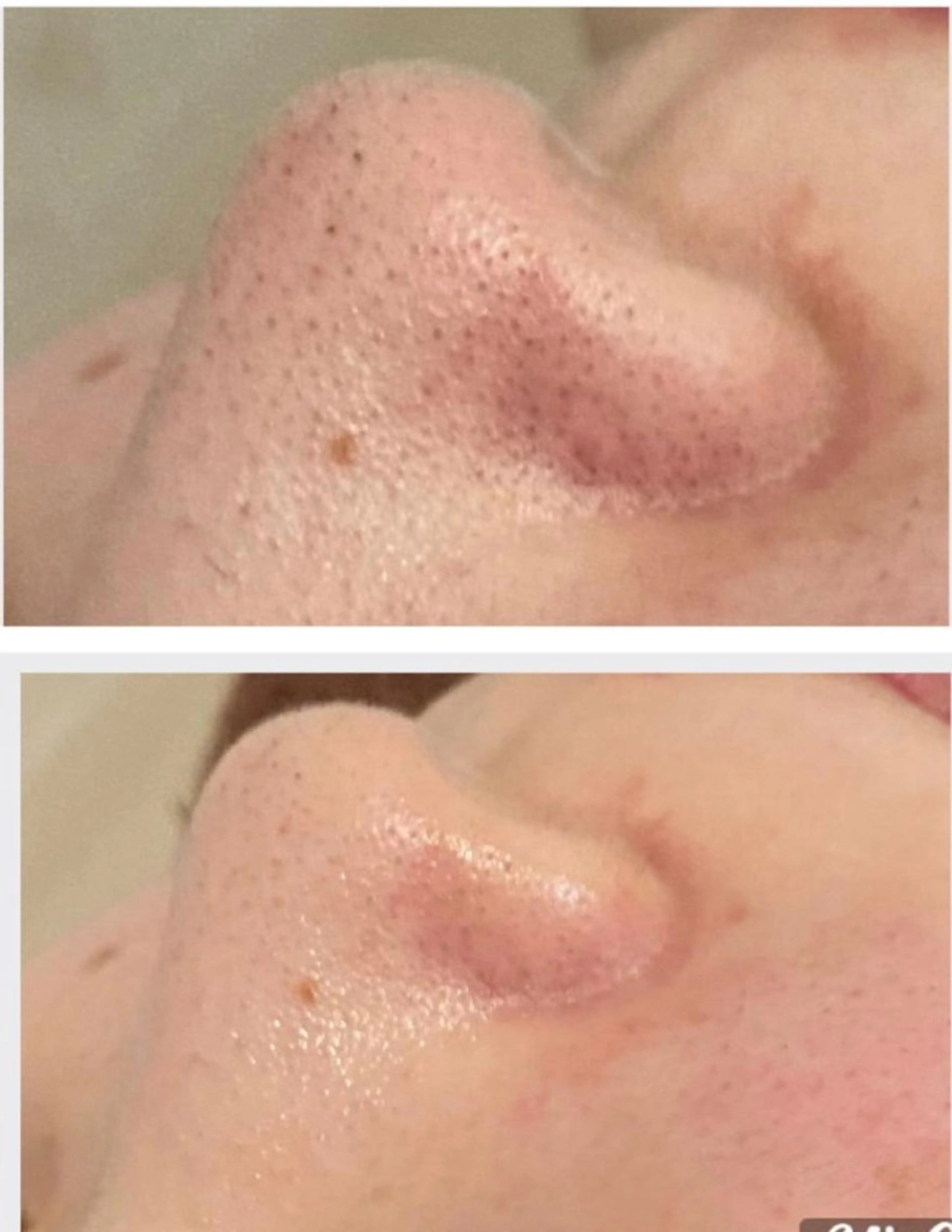 クレンジング・ウォッシングのセルフケアとマシーンによる毛穴吸引コースの写真