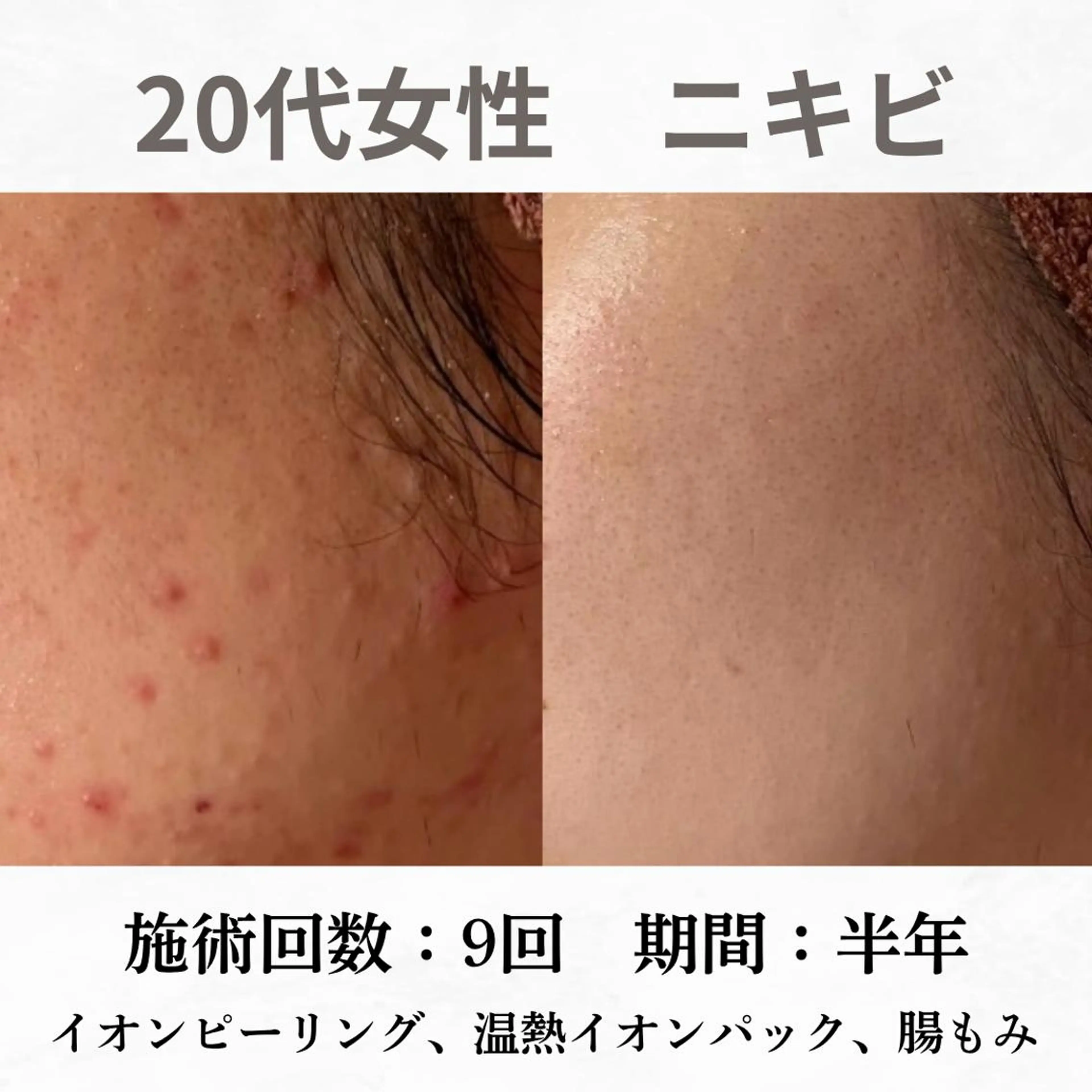 重度ニキビ専門🌷 ダウンタイムなしのエステ・リラクイメージ