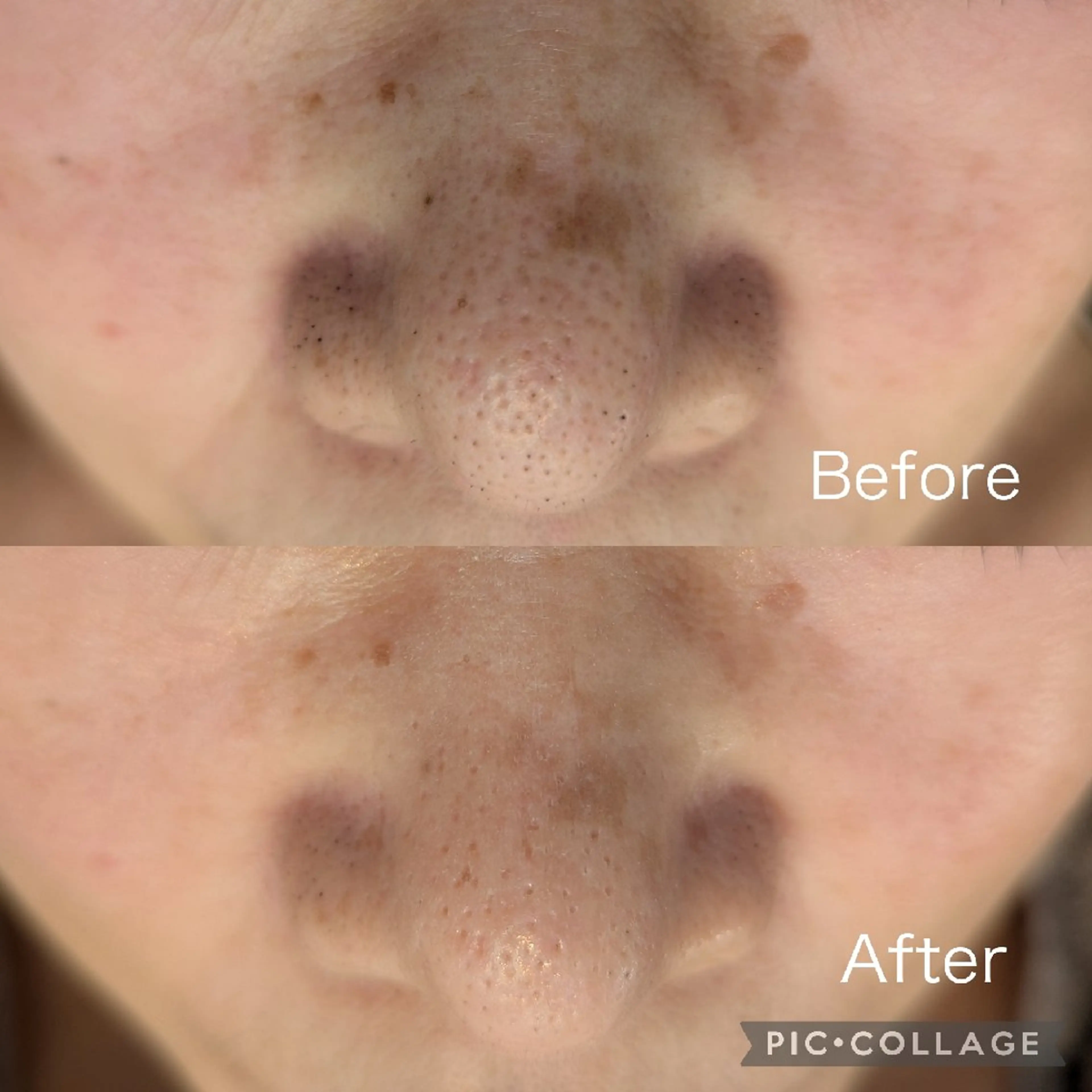 その他 毛穴フェイシャルエステkokotto板橋所属・【毛穴ハーブピーリン グ】板橋1位のエステ・リラクイメージ