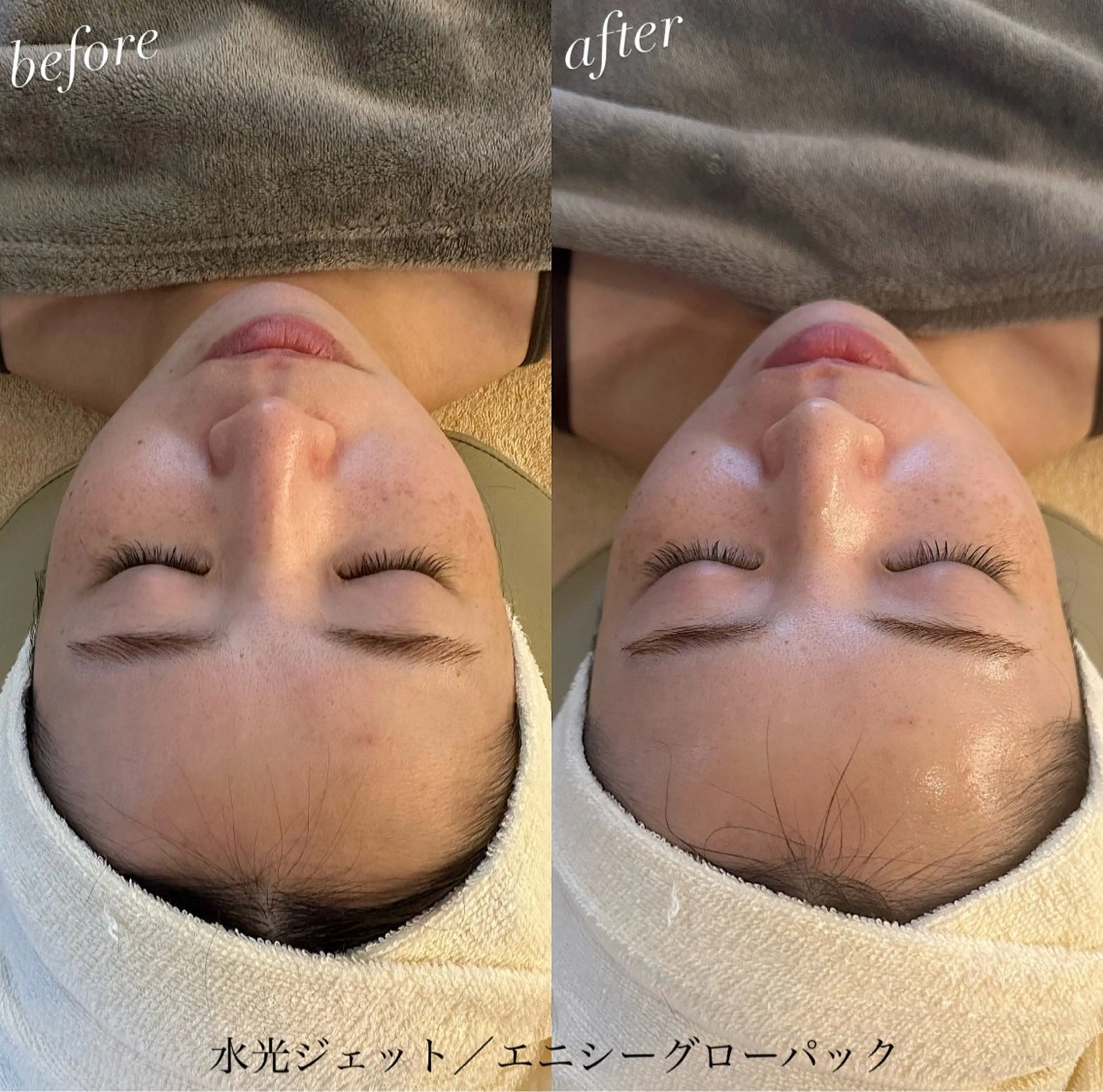 『フェイシャル たるみ‪✕‬むくみ解消コース❄️️️꙳』水光ジェットで小顔効果100点🧏🏼‍♀️ #乾燥の写真