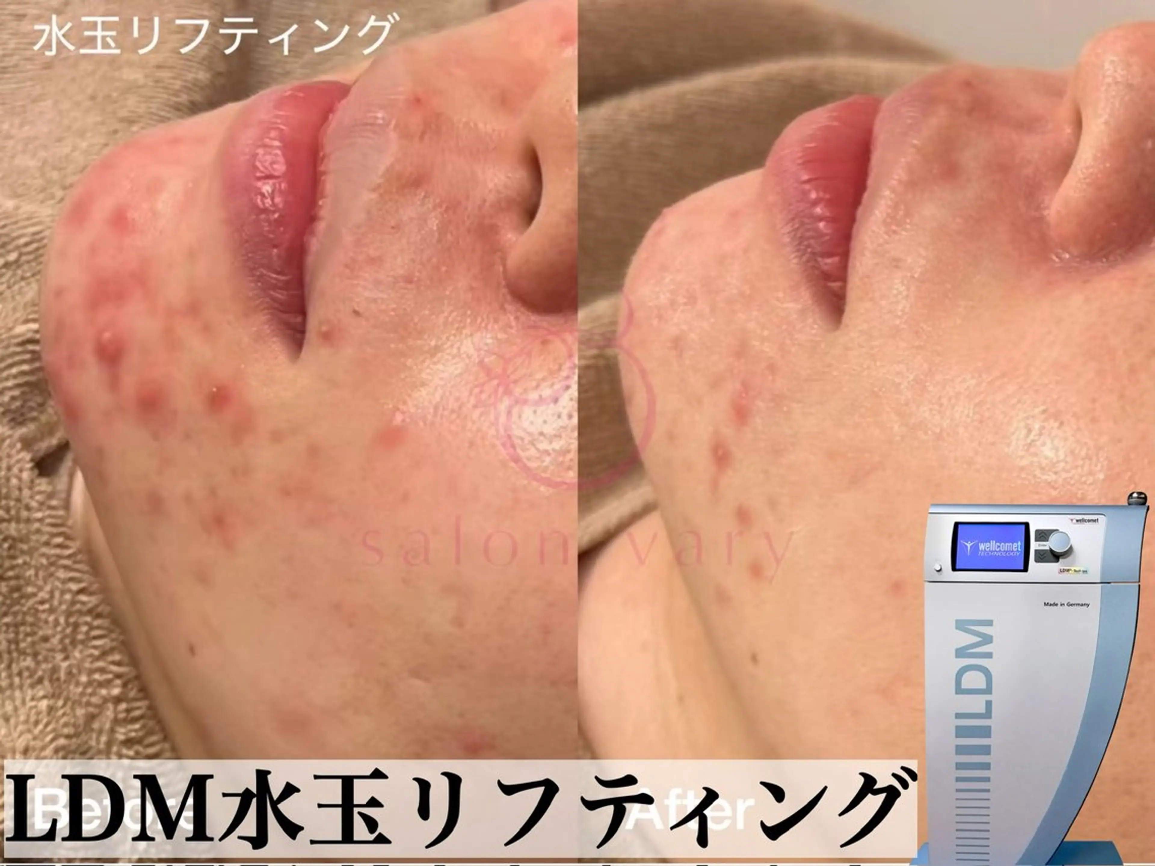 【ニキビケア】水玉リフティングLDMの写真