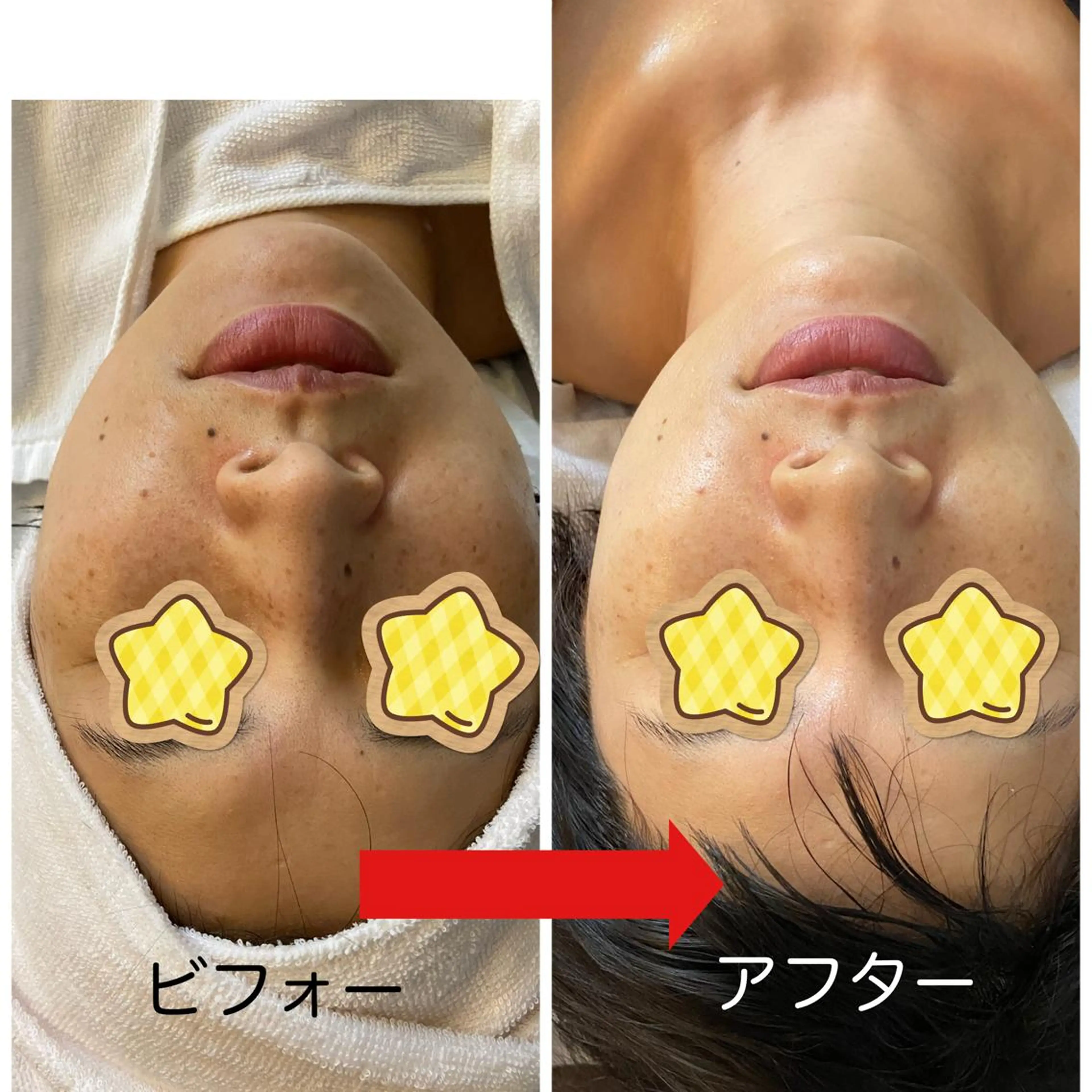 美肌エステ(フェイシャルマッサージ＋トラブル別パック)(50分)の写真
