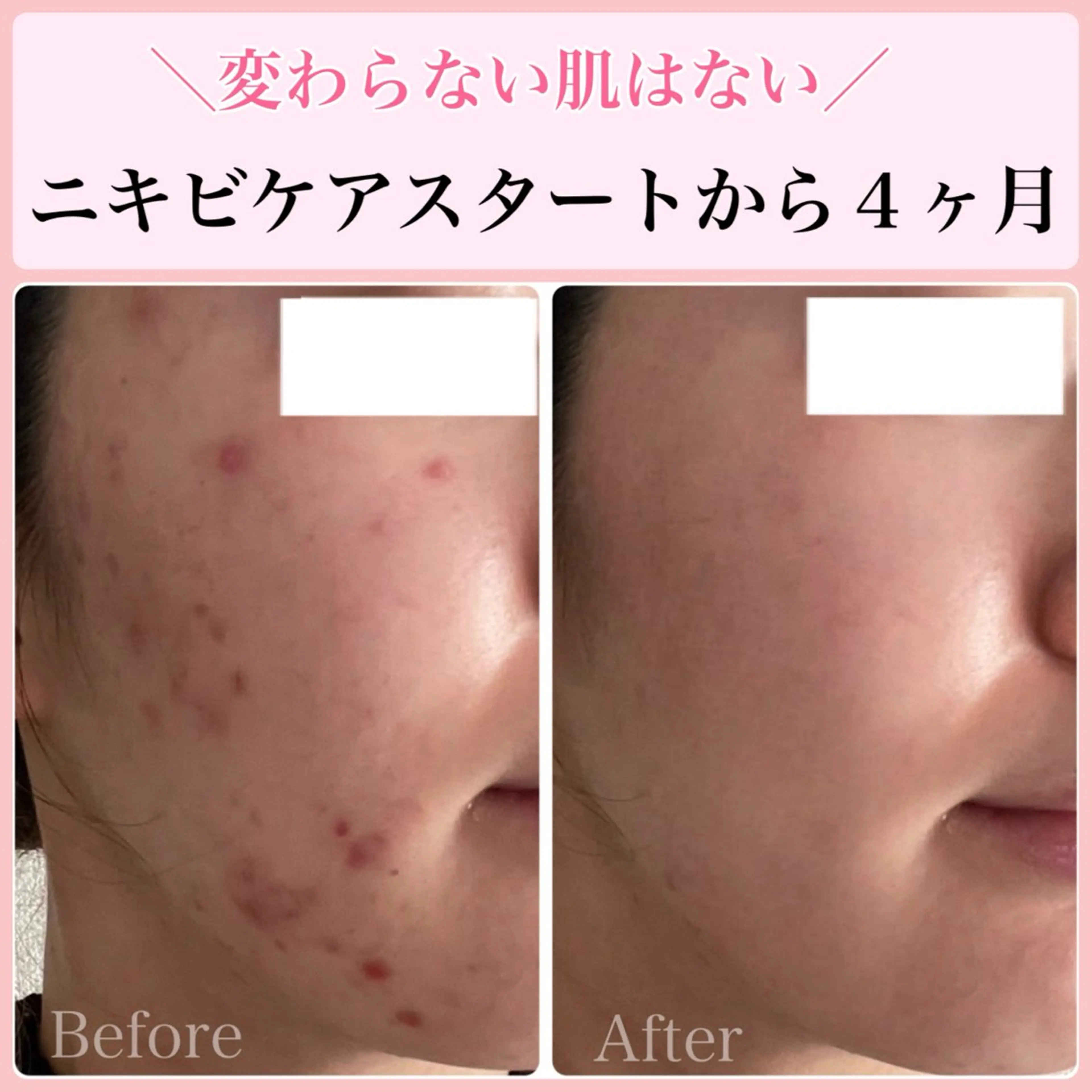 エステ リラク ニキビ・ 肌荒れ専門店のエステ・リラクイメージ