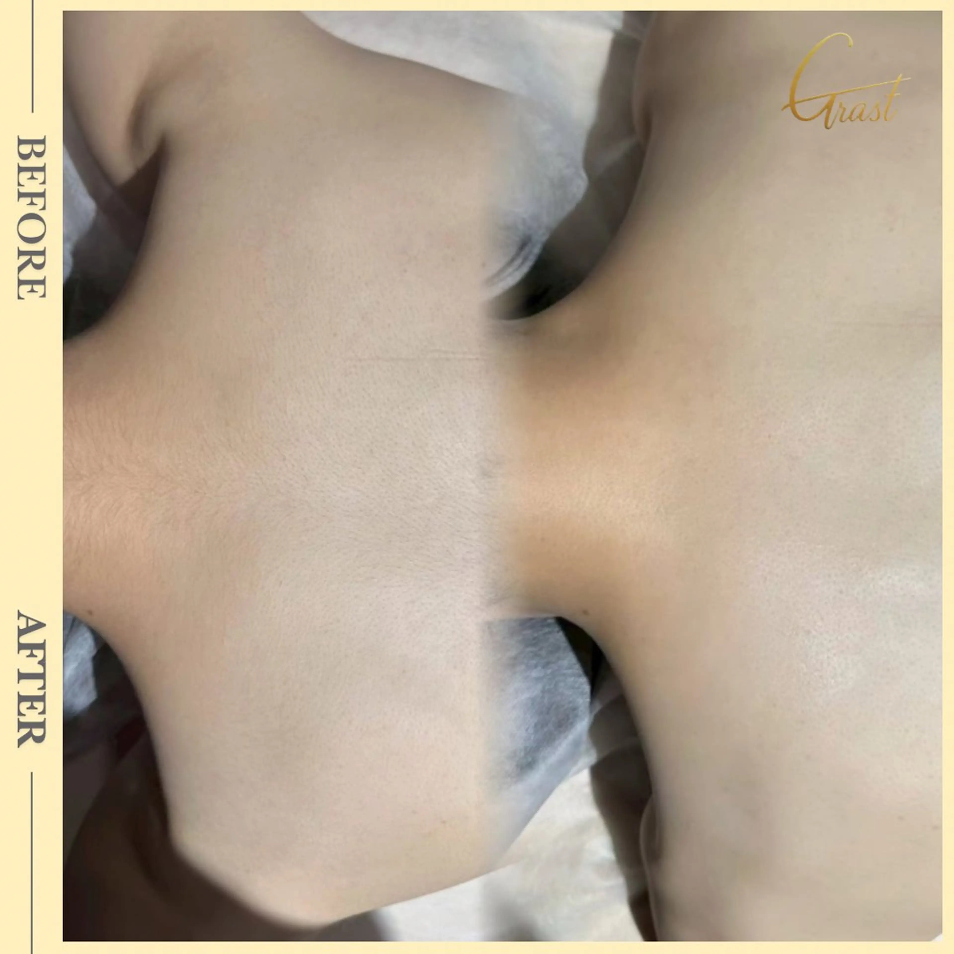 脱毛 ツヤ肌脱毛サロン Grast🌿アイカのエステ・リラクイメージ