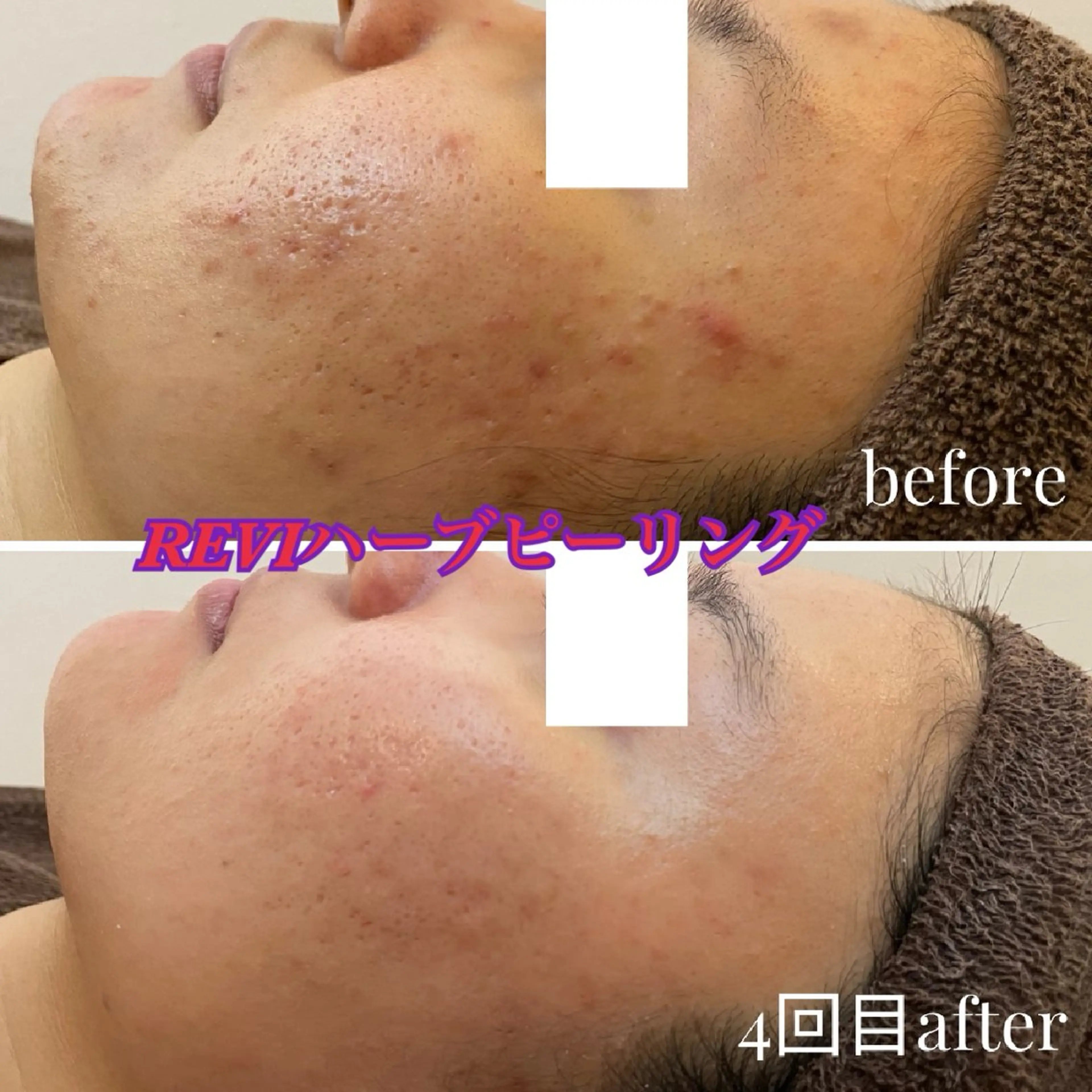 エステ ハーブピーリング専門 毛穴洗浄❤️眉waxのエステ・リラクイメージ