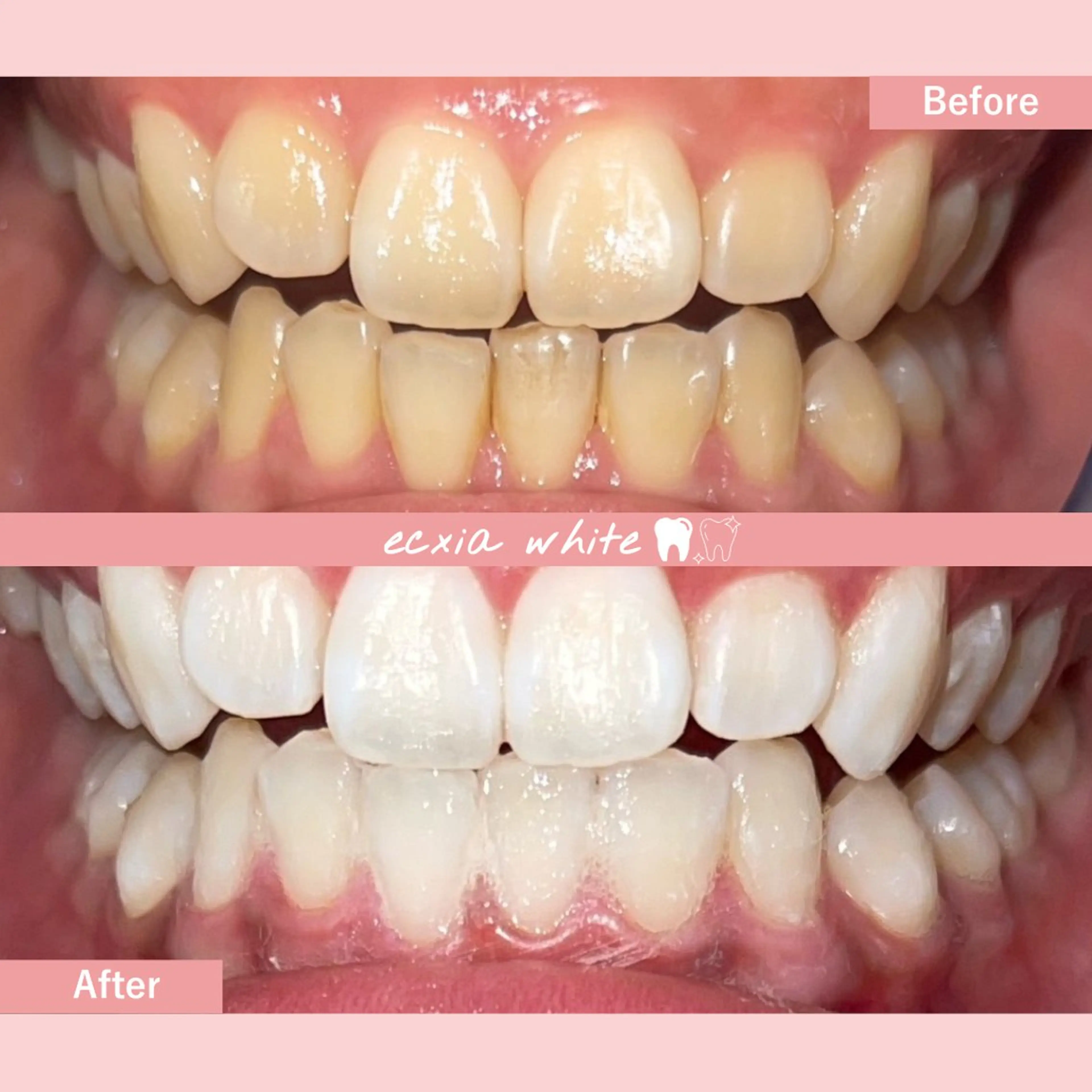 【医療提携ジェル付】6​〜​7トーンUP◎ハイパワーホワイトニング45分照射［札幌/西区/琴似/ホワイトニング］の写真