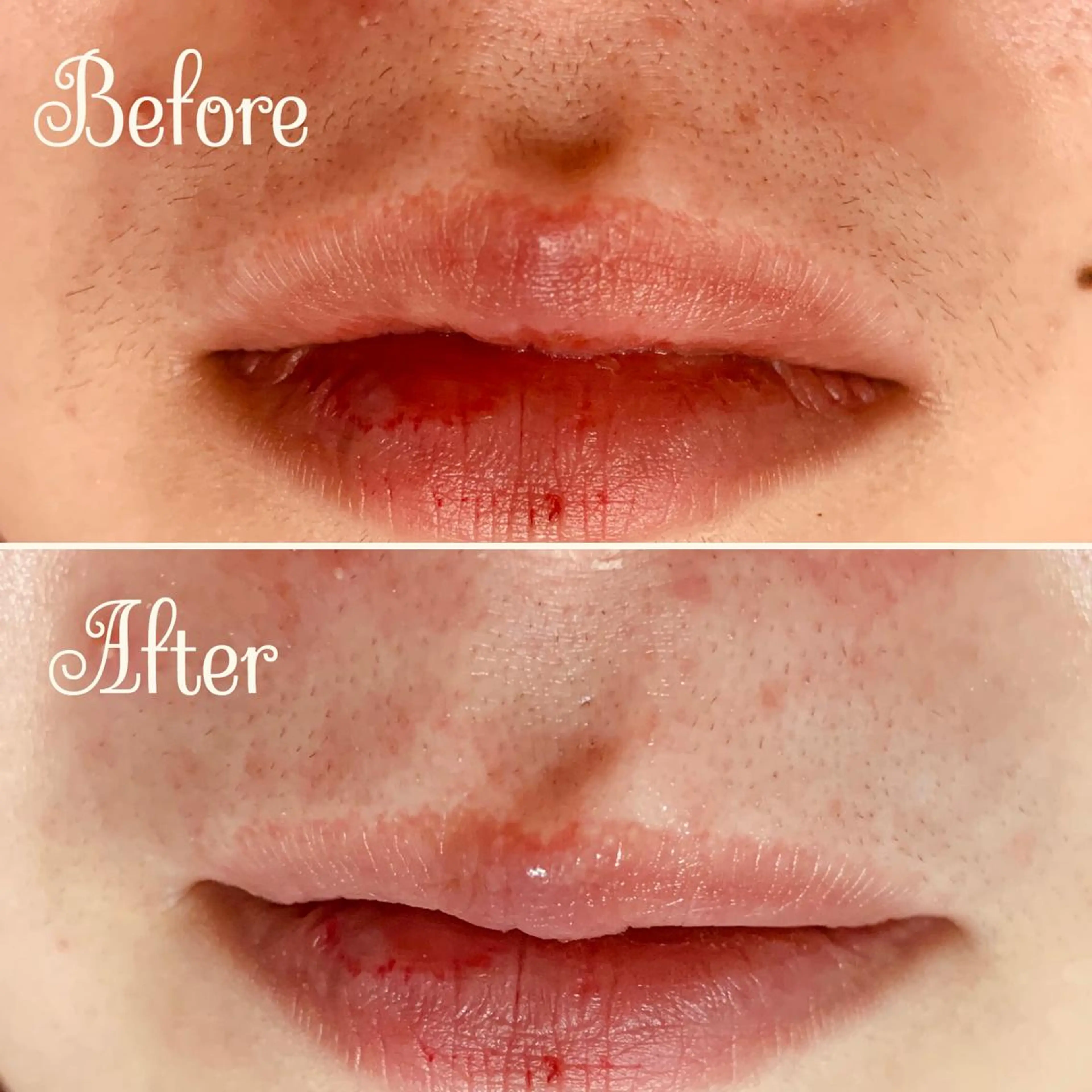 脱毛 Linomalie エステ/たるみ/脱毛のエステ・リラクイメージ