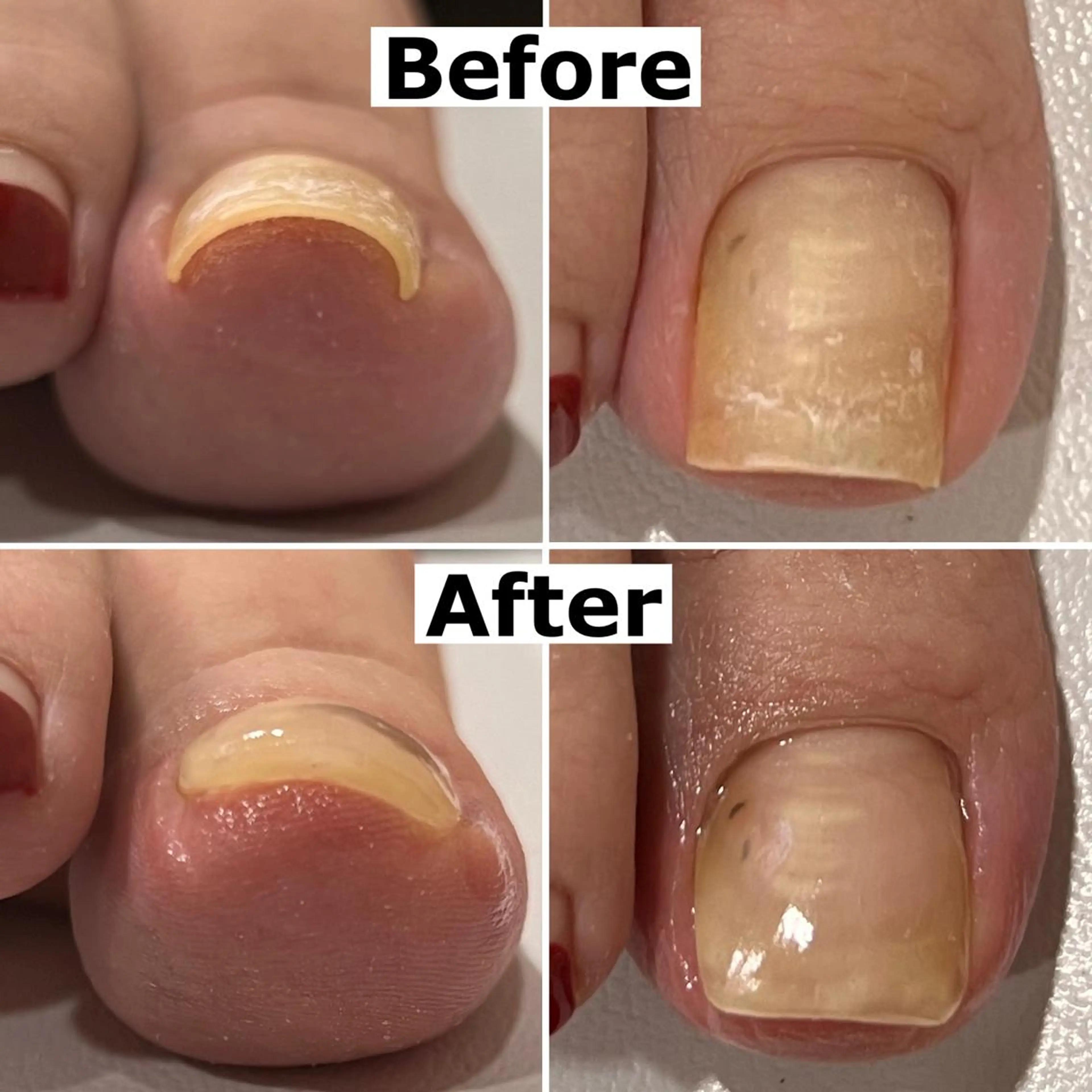 ネイル Mellow nail所属・巻爪無料モデル募集 ✨🦶MEGUMIのネイルデザイン