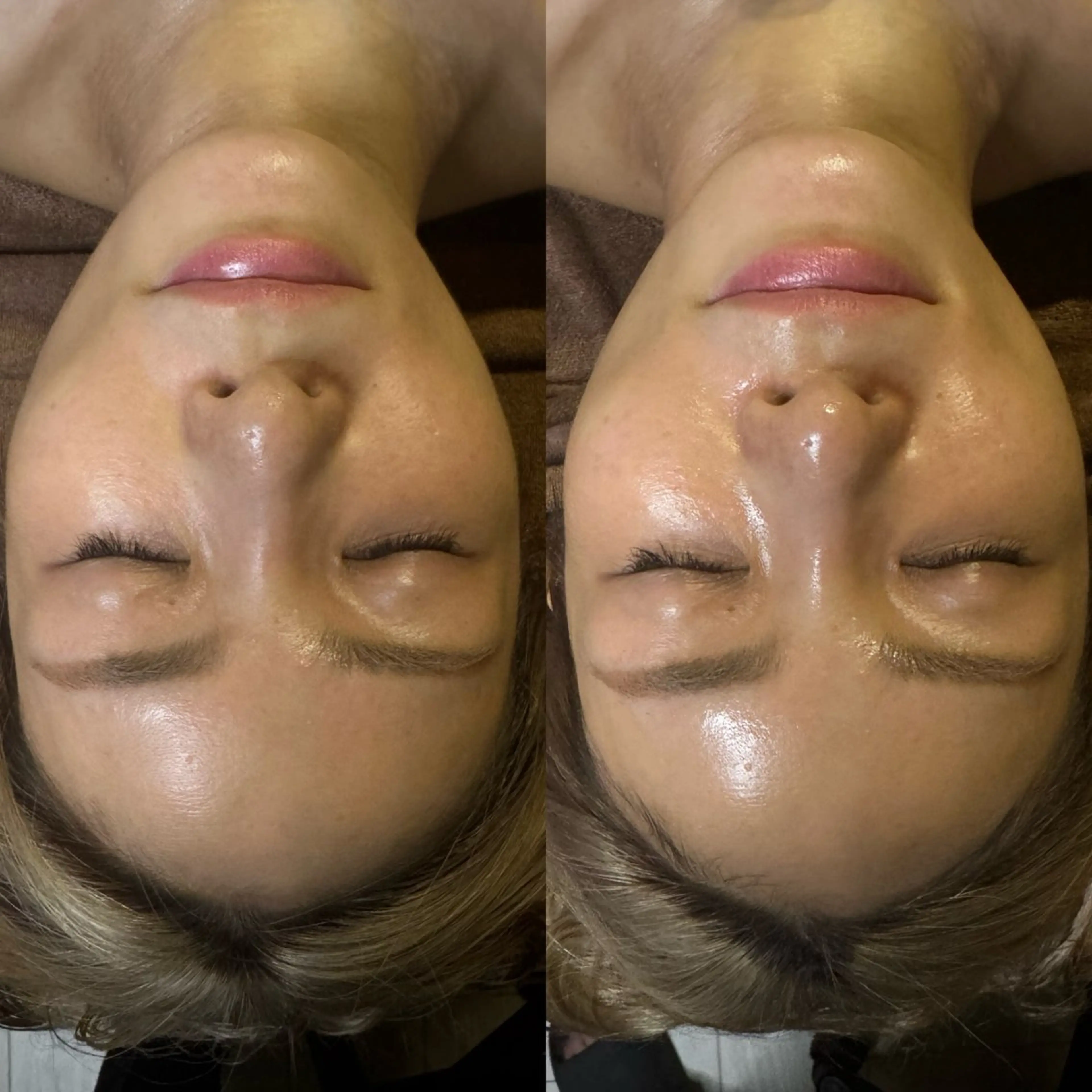 【光フェイシャル】光フェイシャル全顔✨シェービング＆ハイドロパック付き💆‍♀️🫧　¥7,100の写真