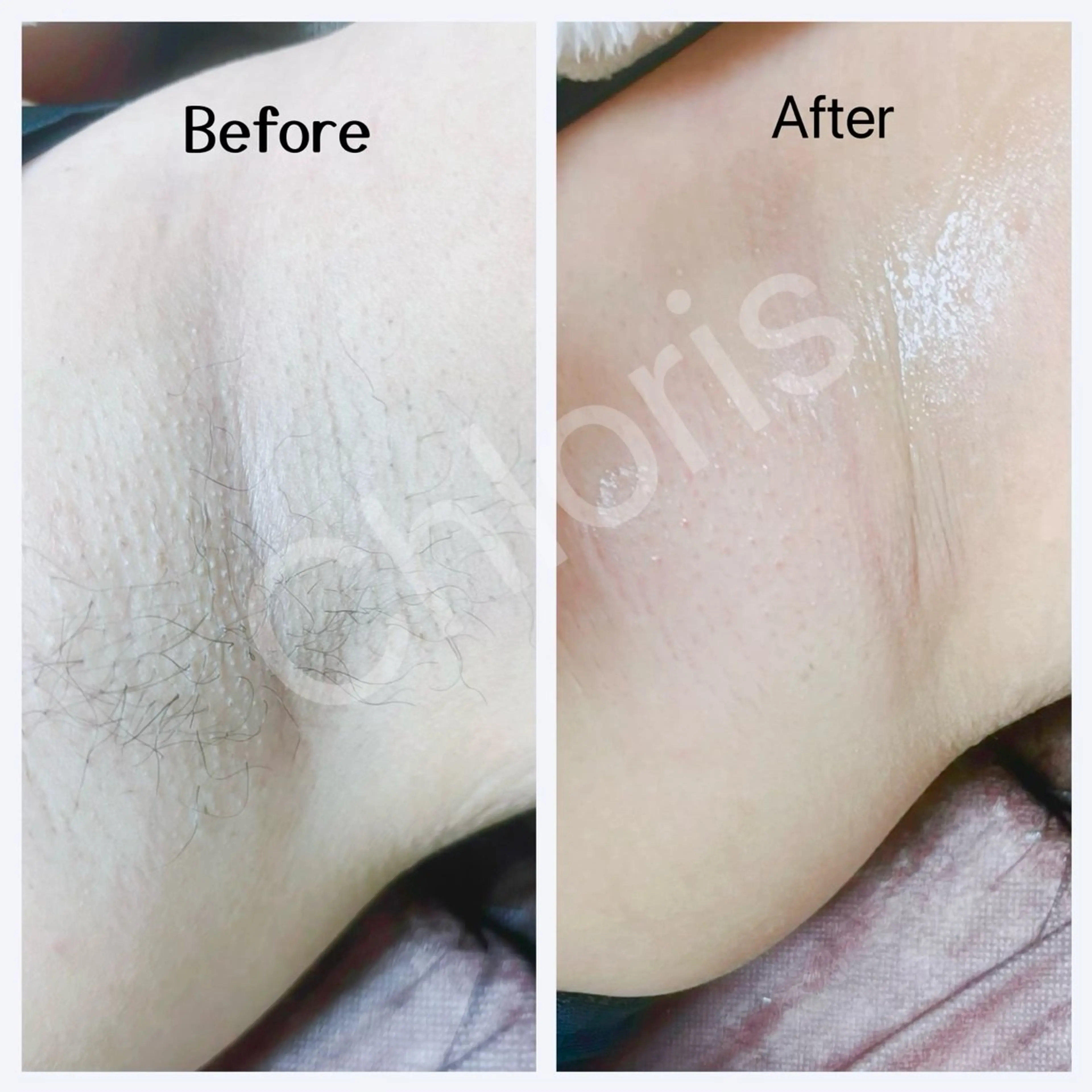 川越デリケートゾーン 光脱毛/ワックス脱毛のエステ・リラクイメージ