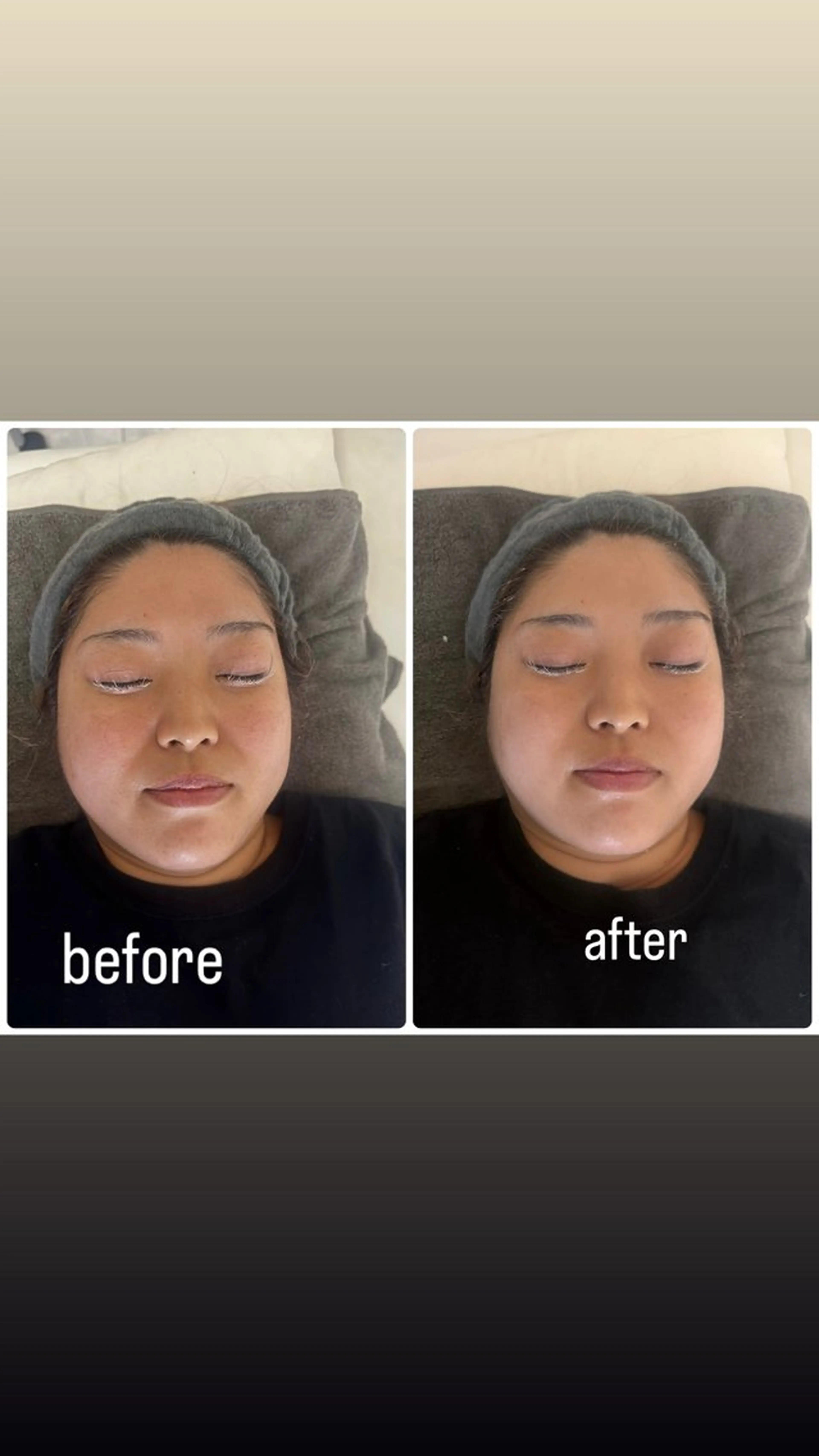 小顔フェイシャル+モデリングパックの写真