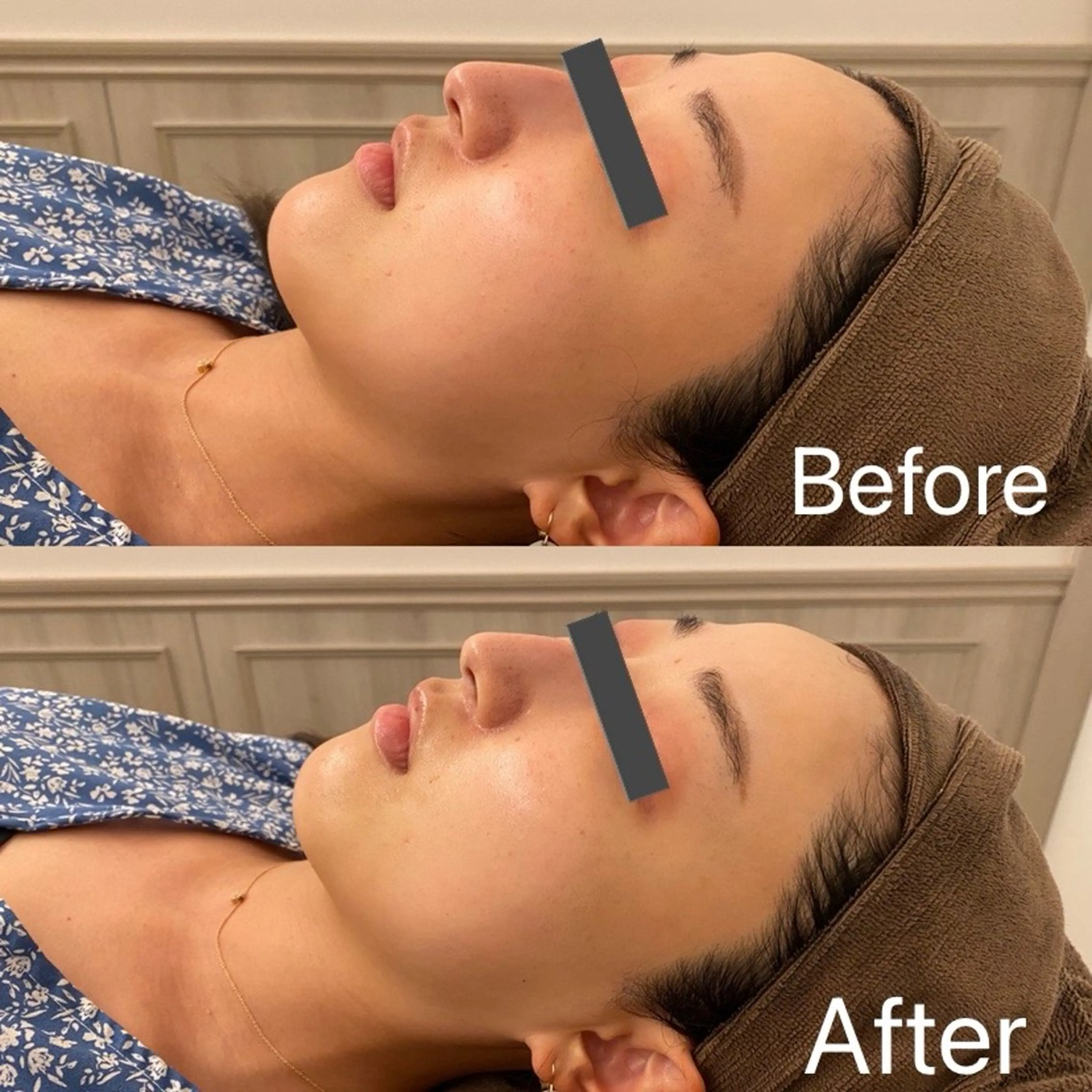 ハイパー光フェイシャルエステの写真