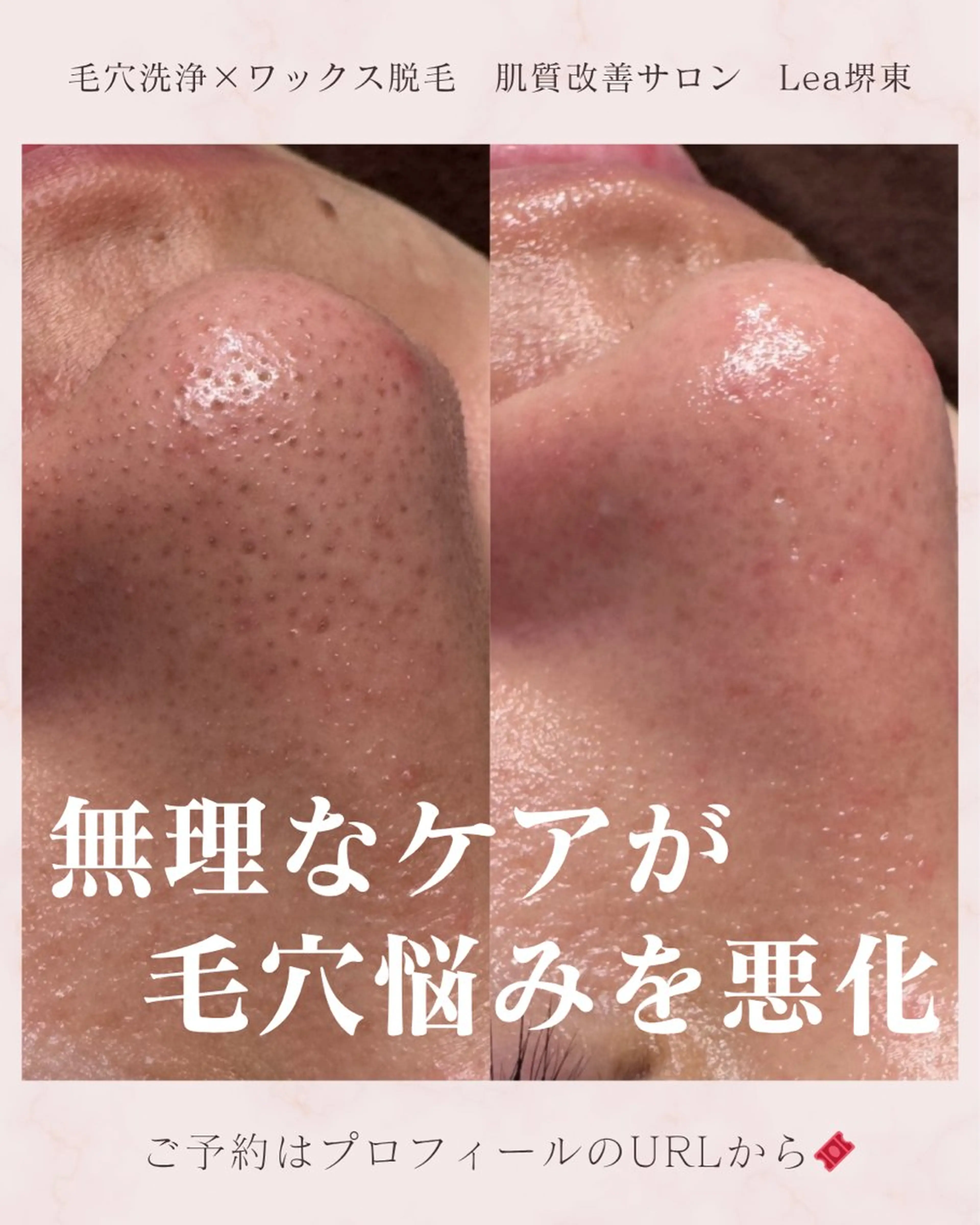 エステ Lea堺東　毛穴洗浄 ×顔ワックス脱毛のその他イメージ