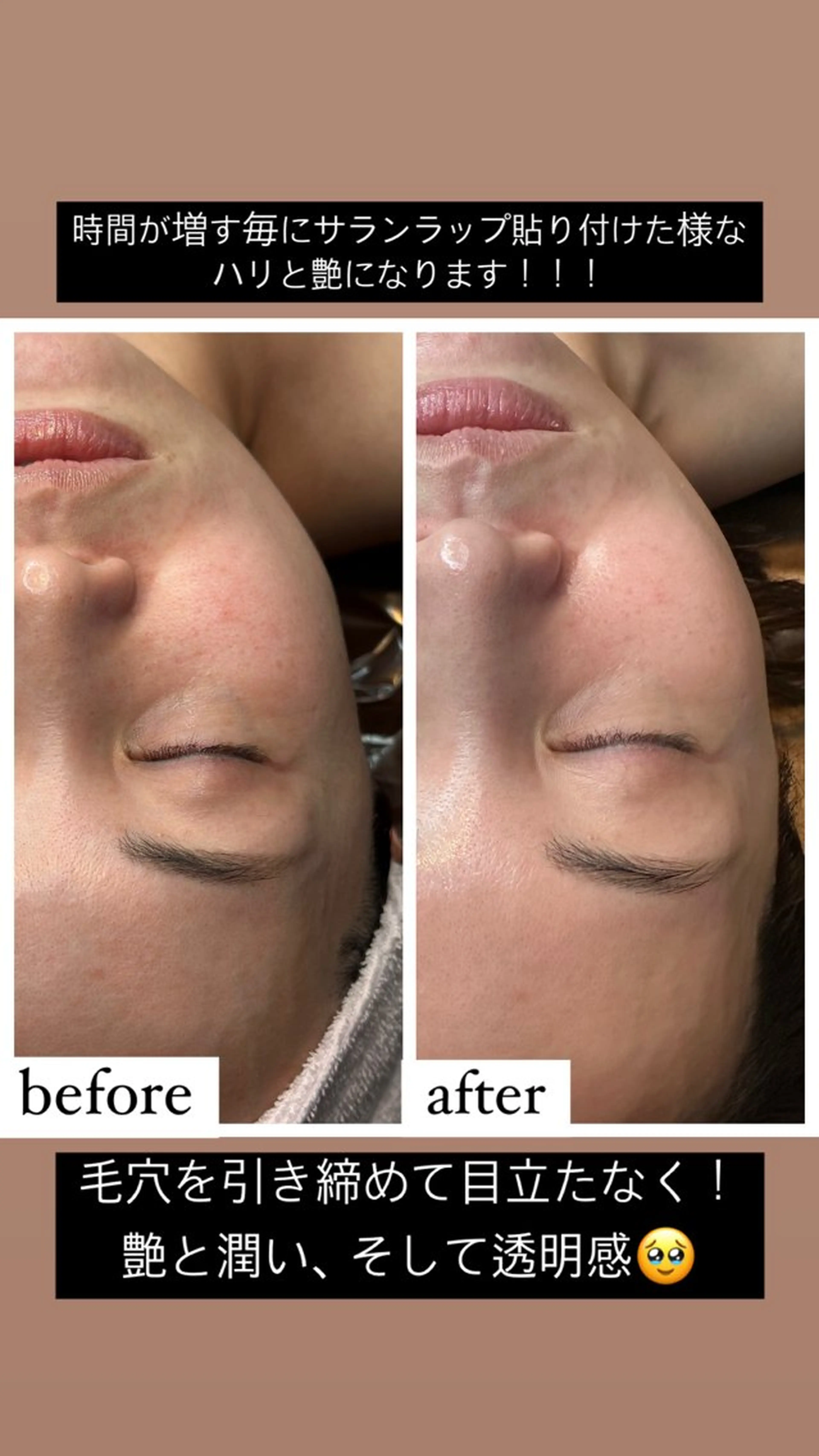 ホワイトスノーピール▶︎肌表面のくすみやシミ、ニキビ跡、ゴワつきに1回の施術でなめらかな透明肌を引き出しますの写真