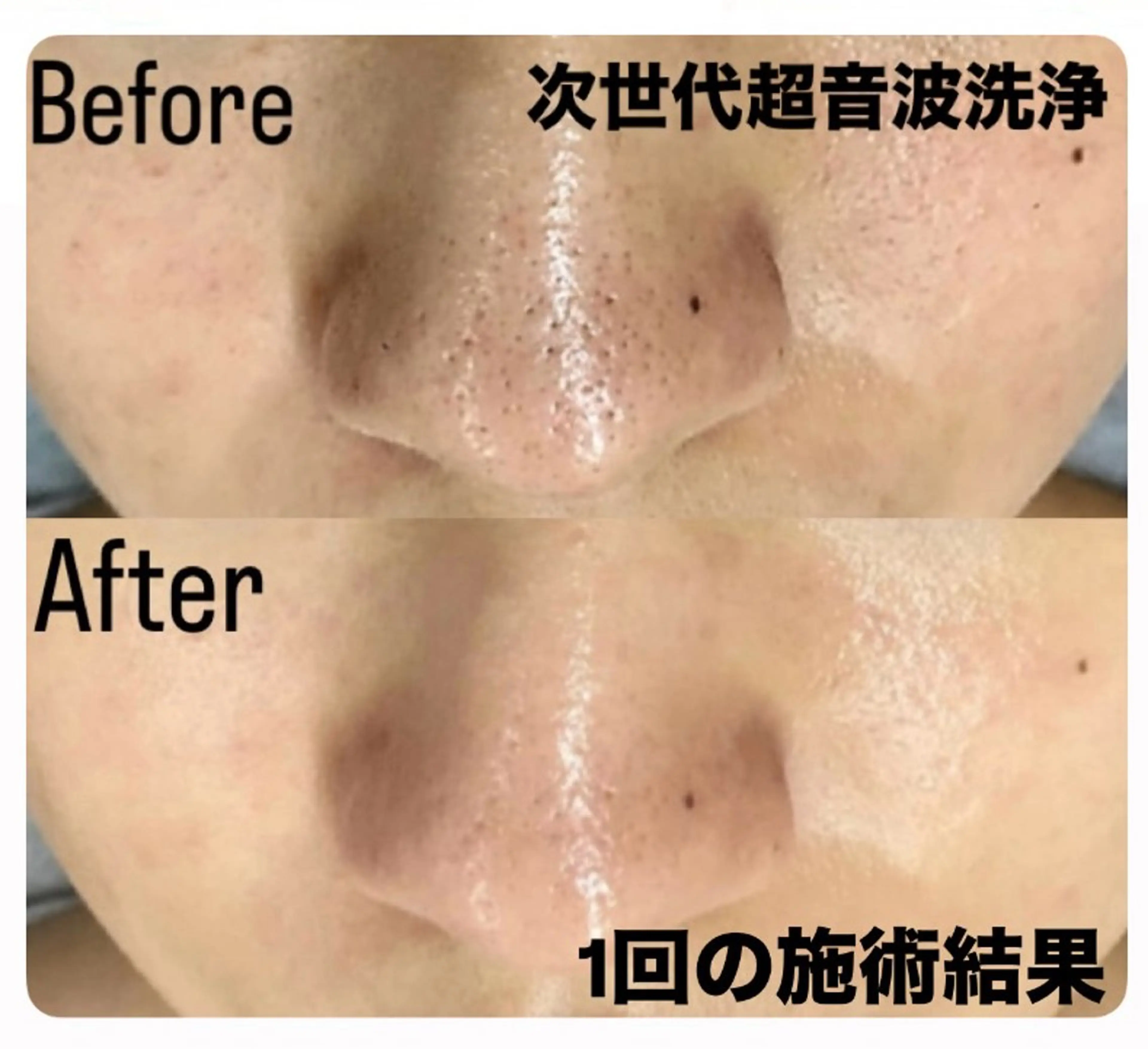 大好評10時~15時限定★魅惑のうる艶肌プルプル毛穴洗浄&イオン導入+パッティング韓国白玉レチノール+ヘッドスパ付きの写真