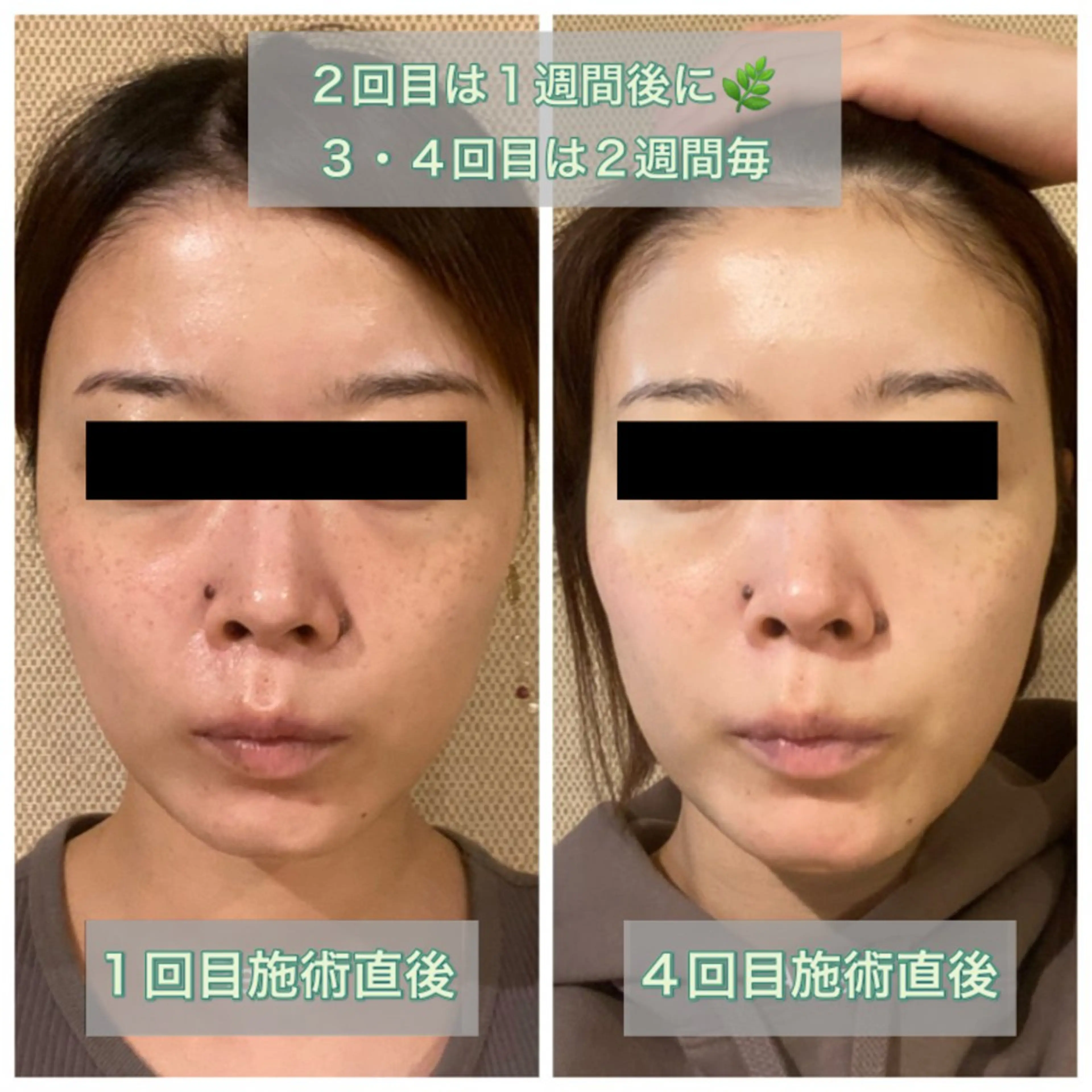 【当サロンでのハーブピーリングが初めての方限定】ハーブピーリング ¥9800→¥6980の写真