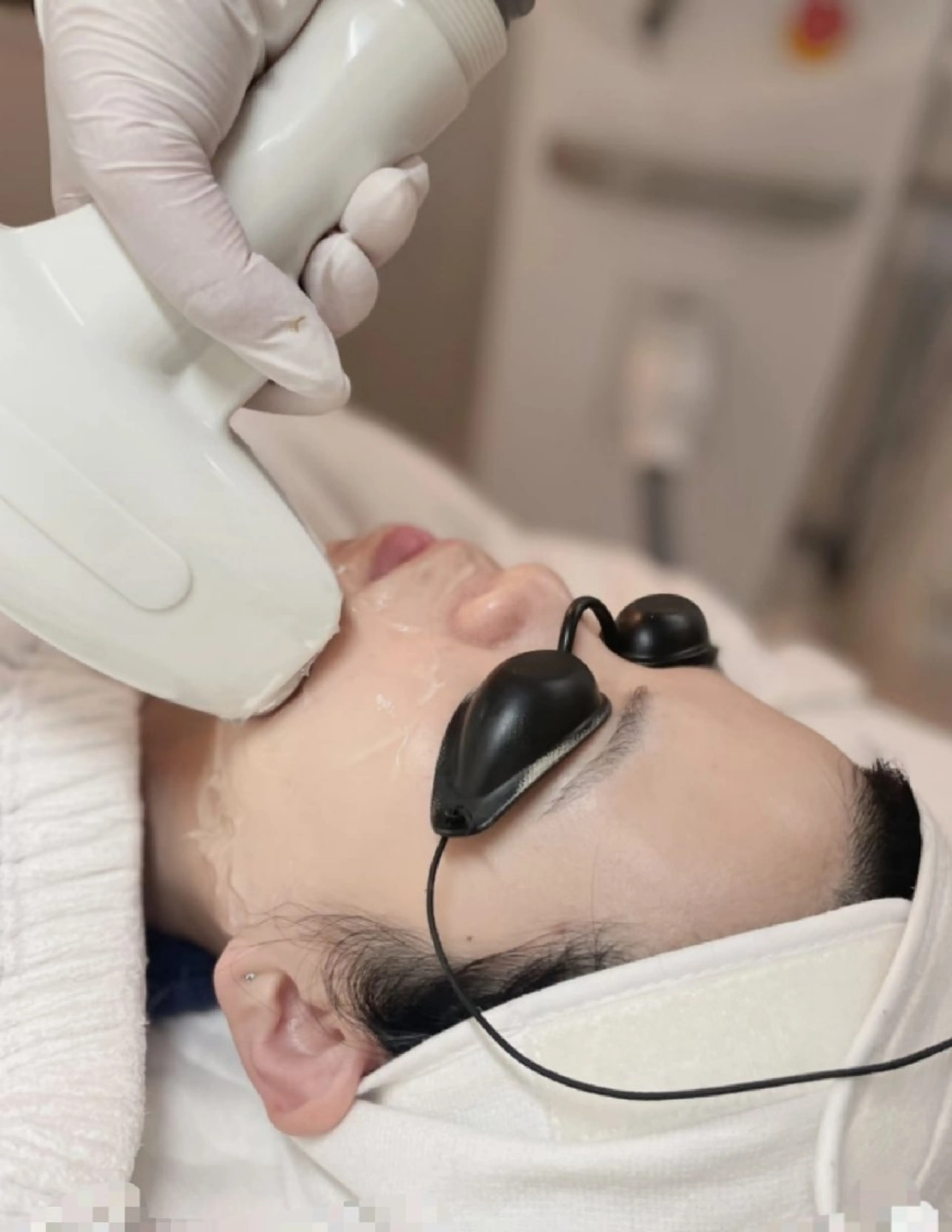 【大人気美肌顔脱毛】全顔2980&メンズも大歓迎の写真