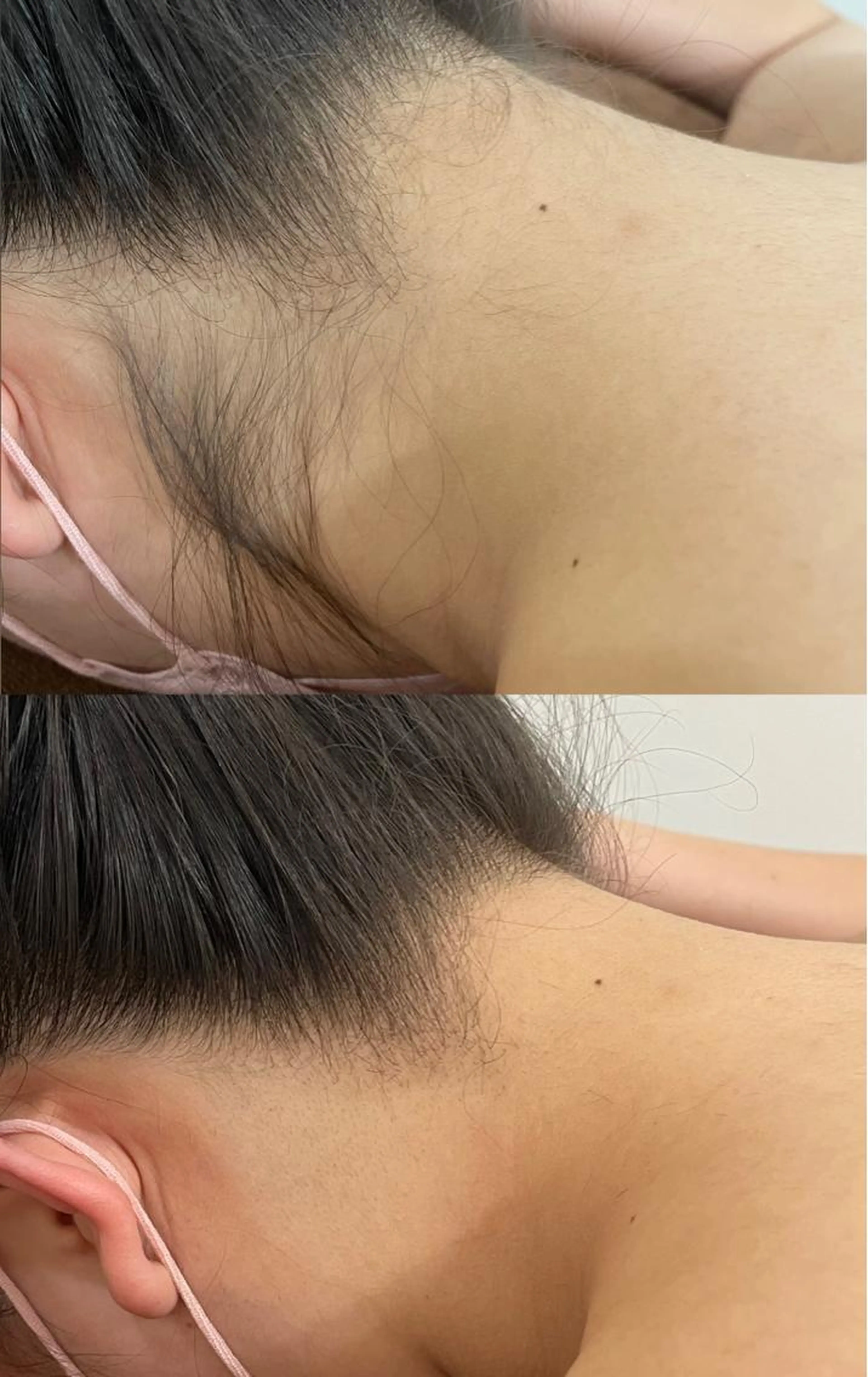 ミニモ限定💓レディース全身脱毛✨うなじ、VIO、お顔ありの写真