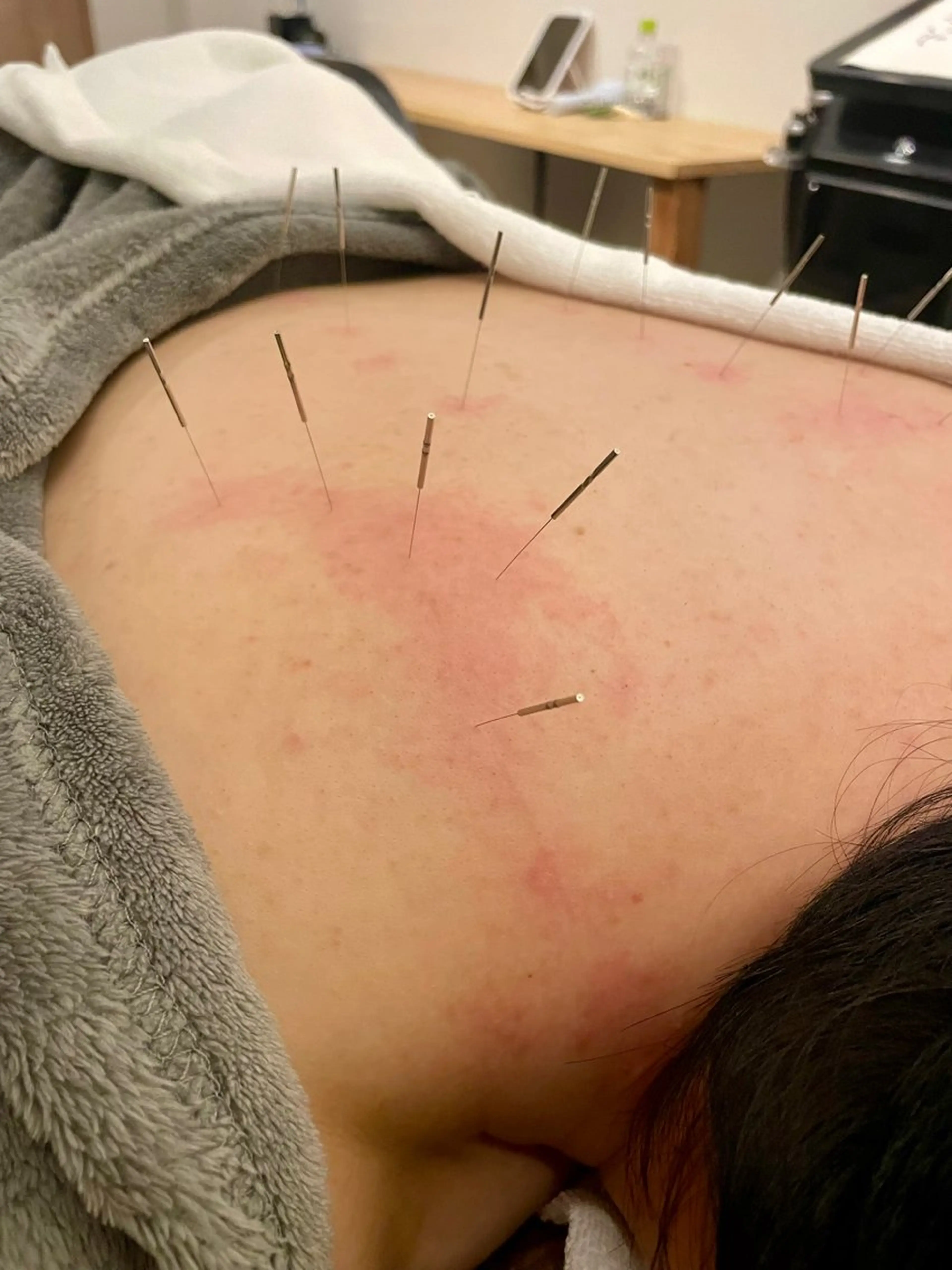 美容鍼/鍼灸 ここみ鍼灸院のエステ・リラクイメージ