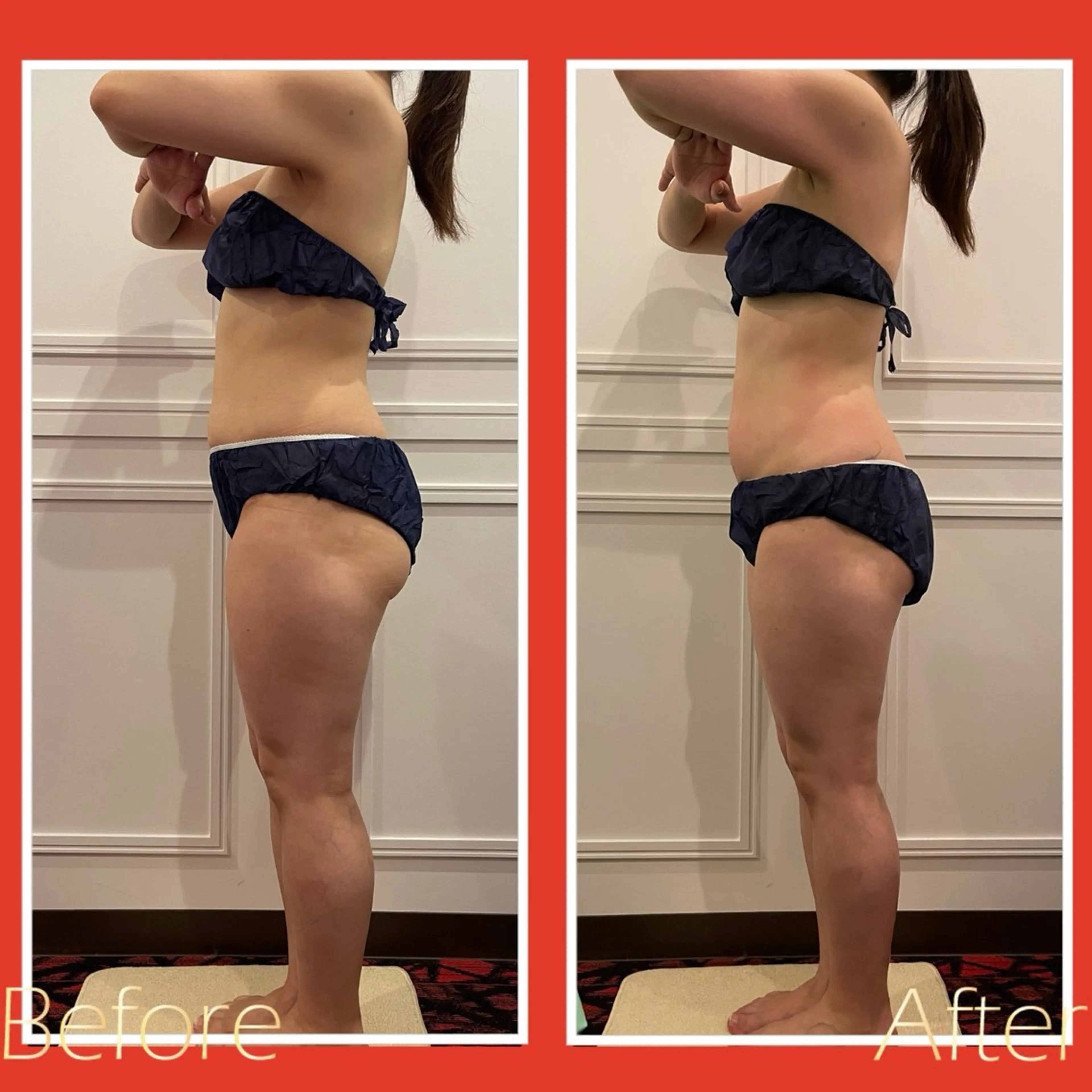 イベント前に！ハイパーナイフ痩身エステ🔥上半身or下半身選べる3回集中ケア💪ガッツリBODYライン作り👙の写真