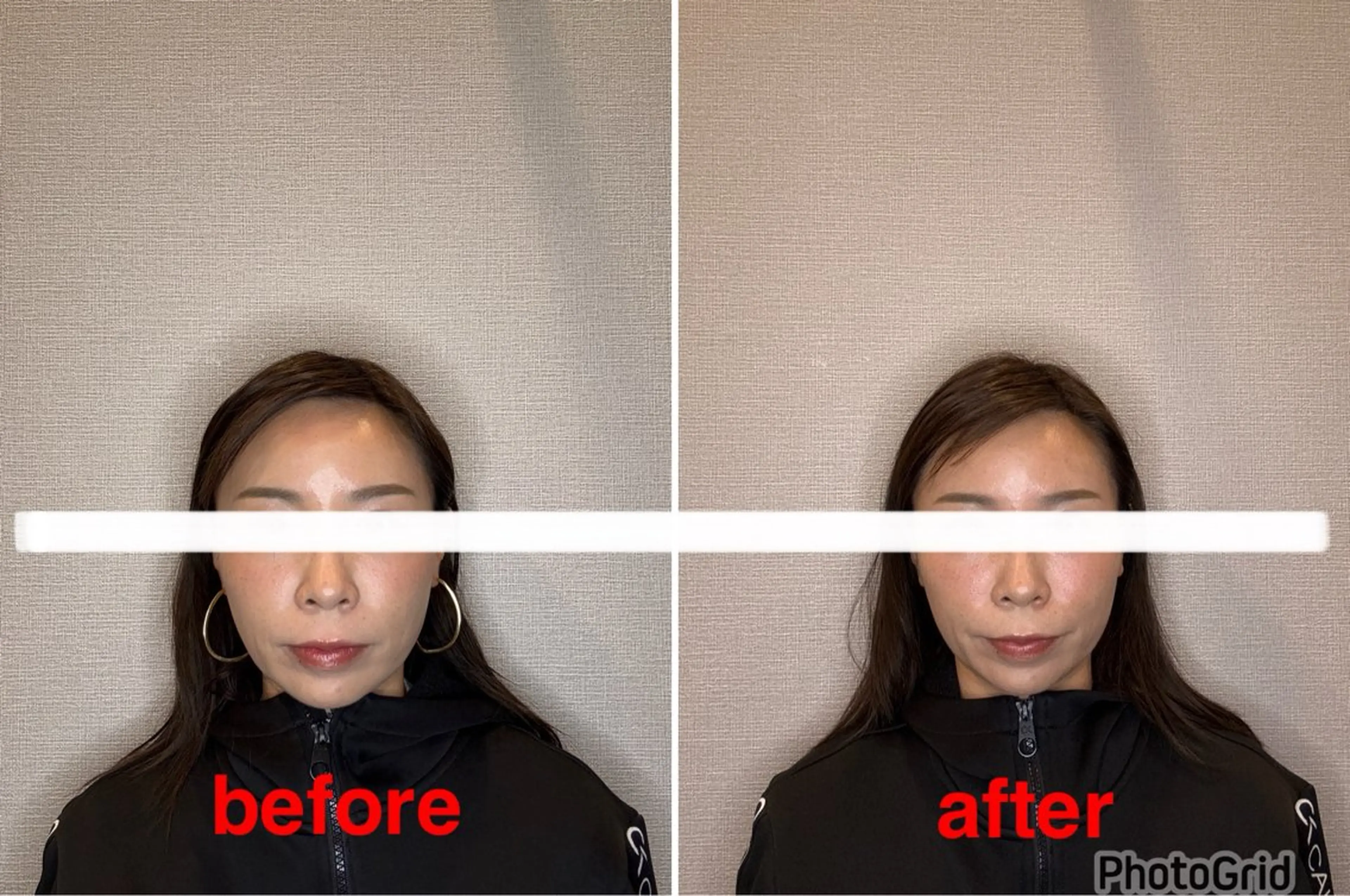 【午前限定】📸before/after写真募集中✨お悩み集中ケア美容鍼10本※補足説明をご確認くださいの写真