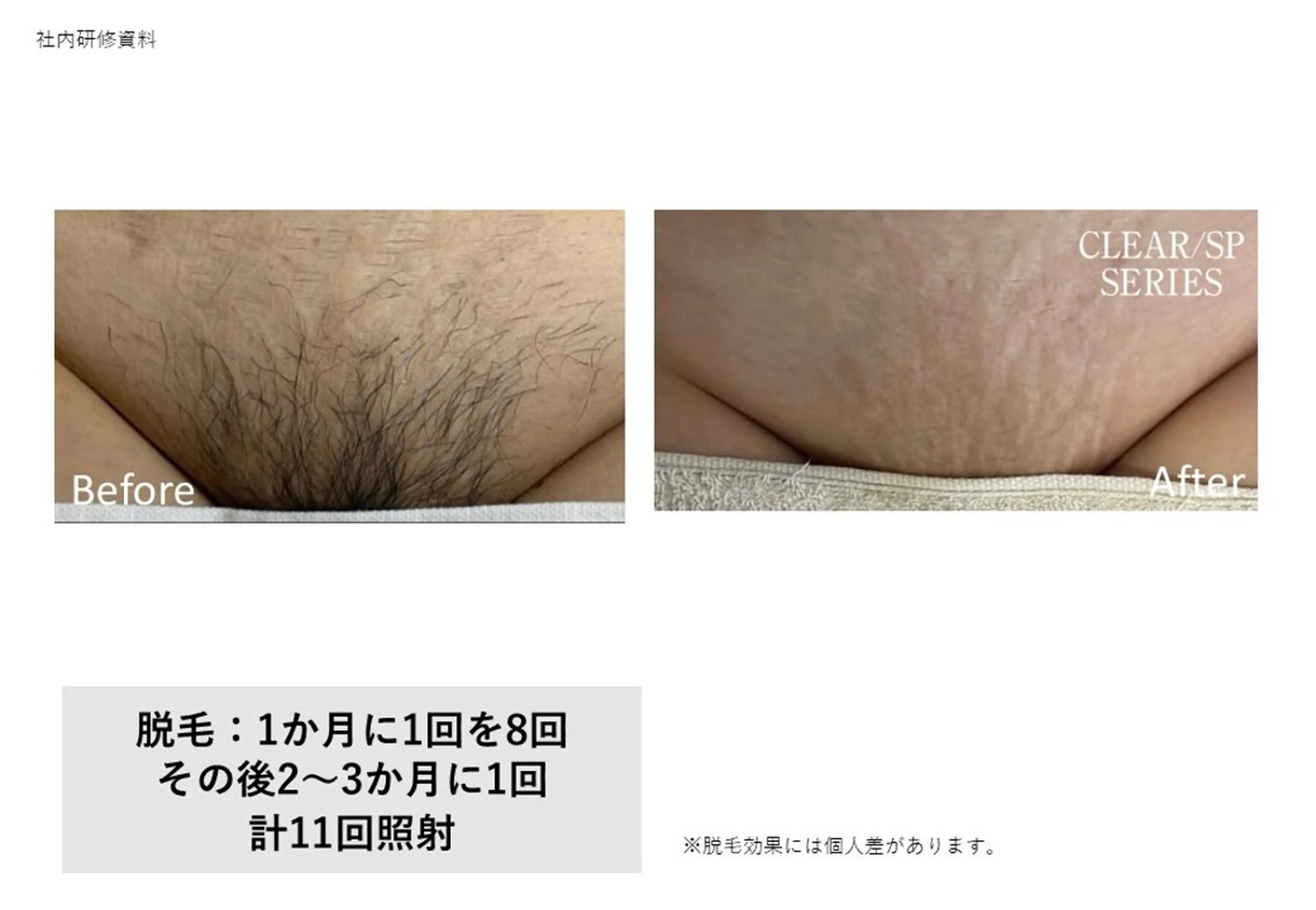 脱毛 野口 茂宰のヘアスタイル