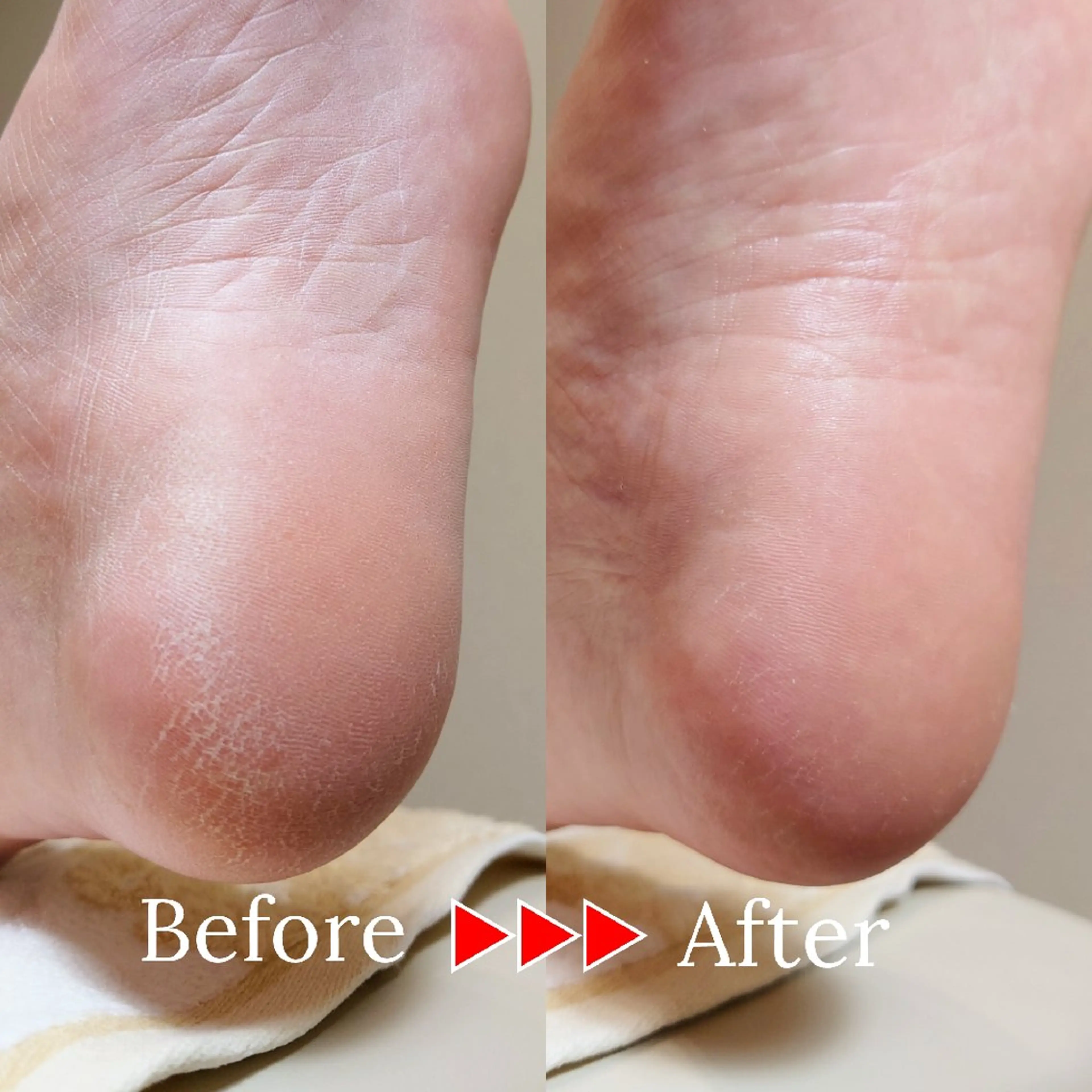 【かかとガサガサ悩みに】足裏角質ケアの写真