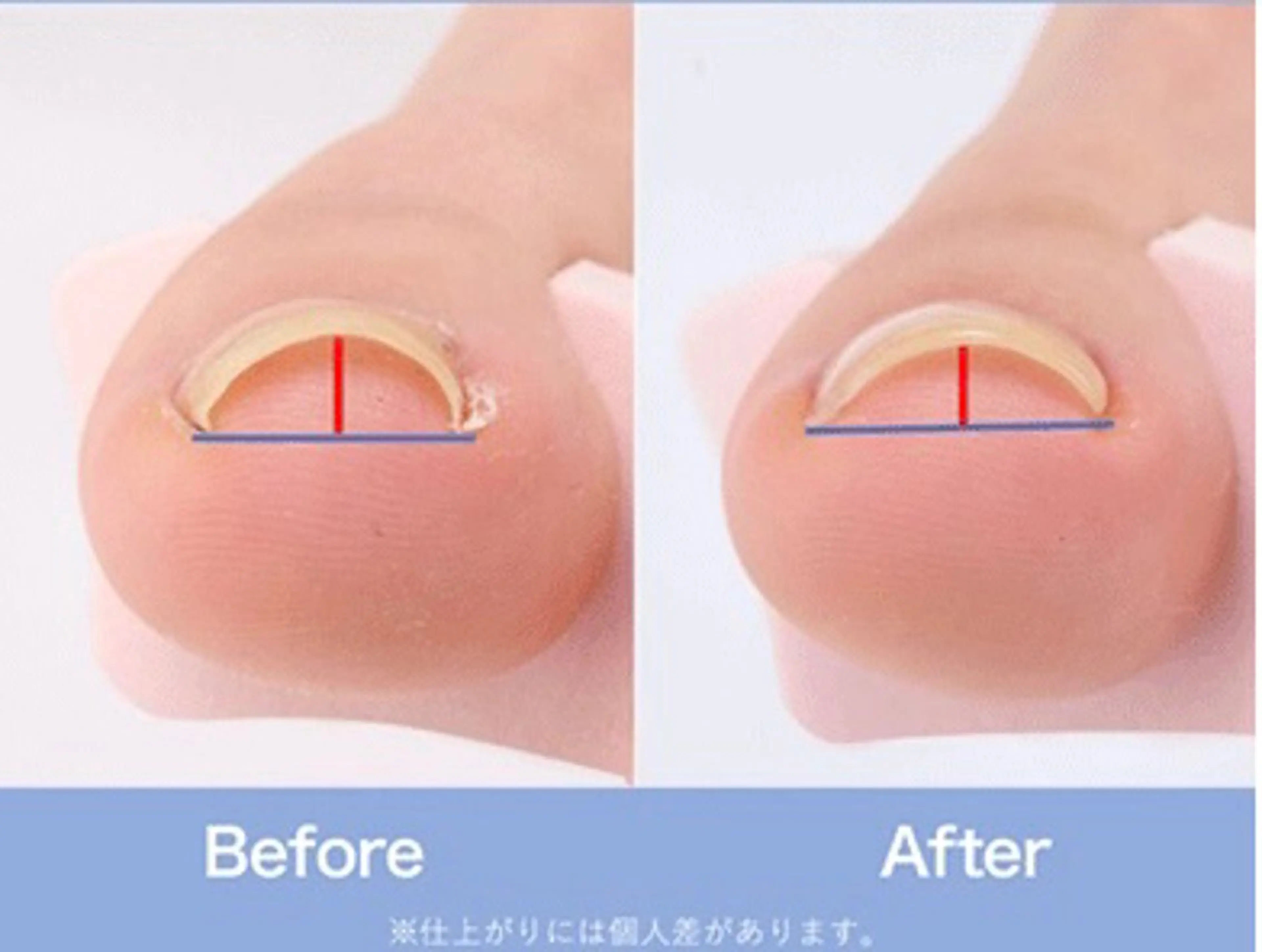 巻き爪ケア1本3300円の写真