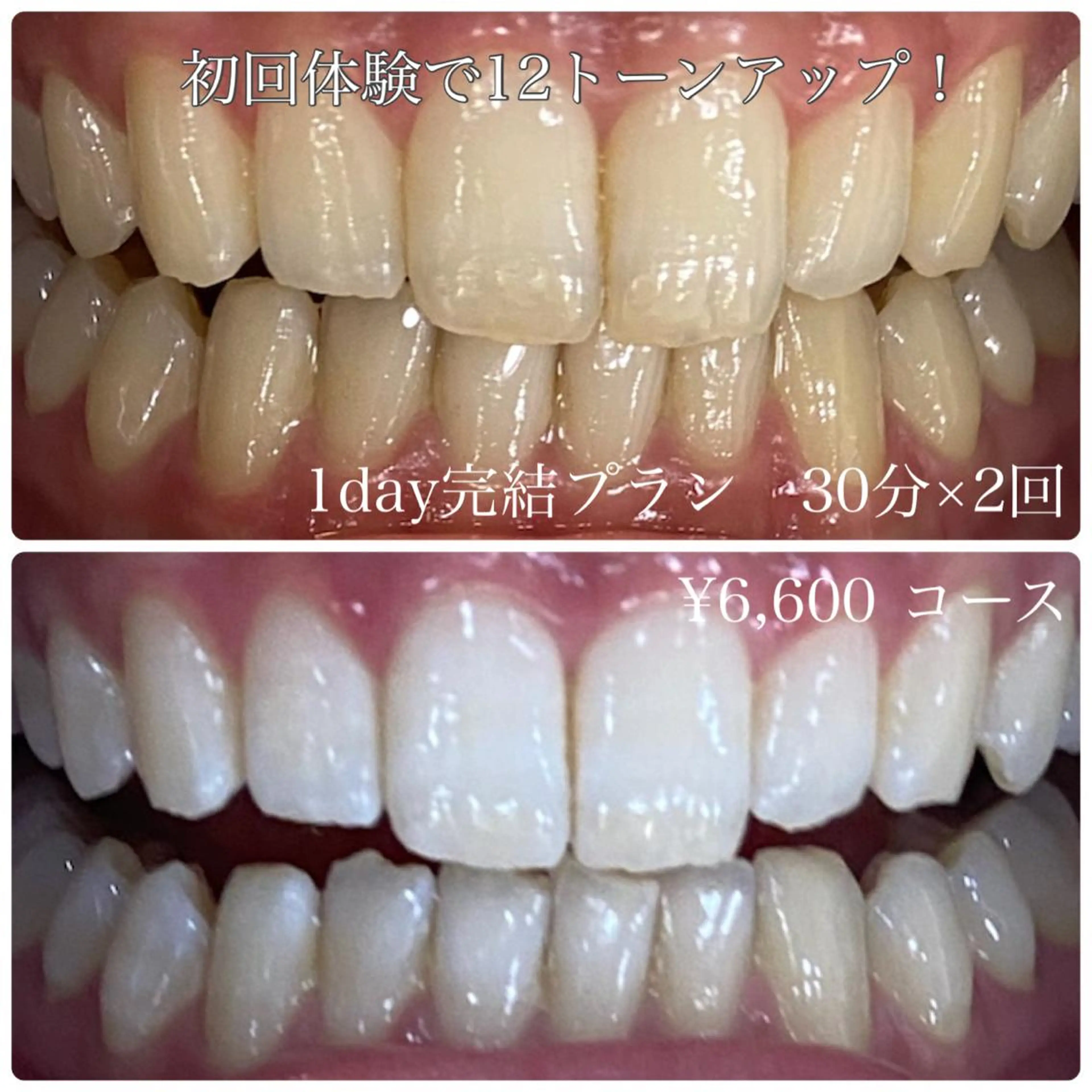 【高校生限定】　セルフホワイトニング　30分🦷✨の写真