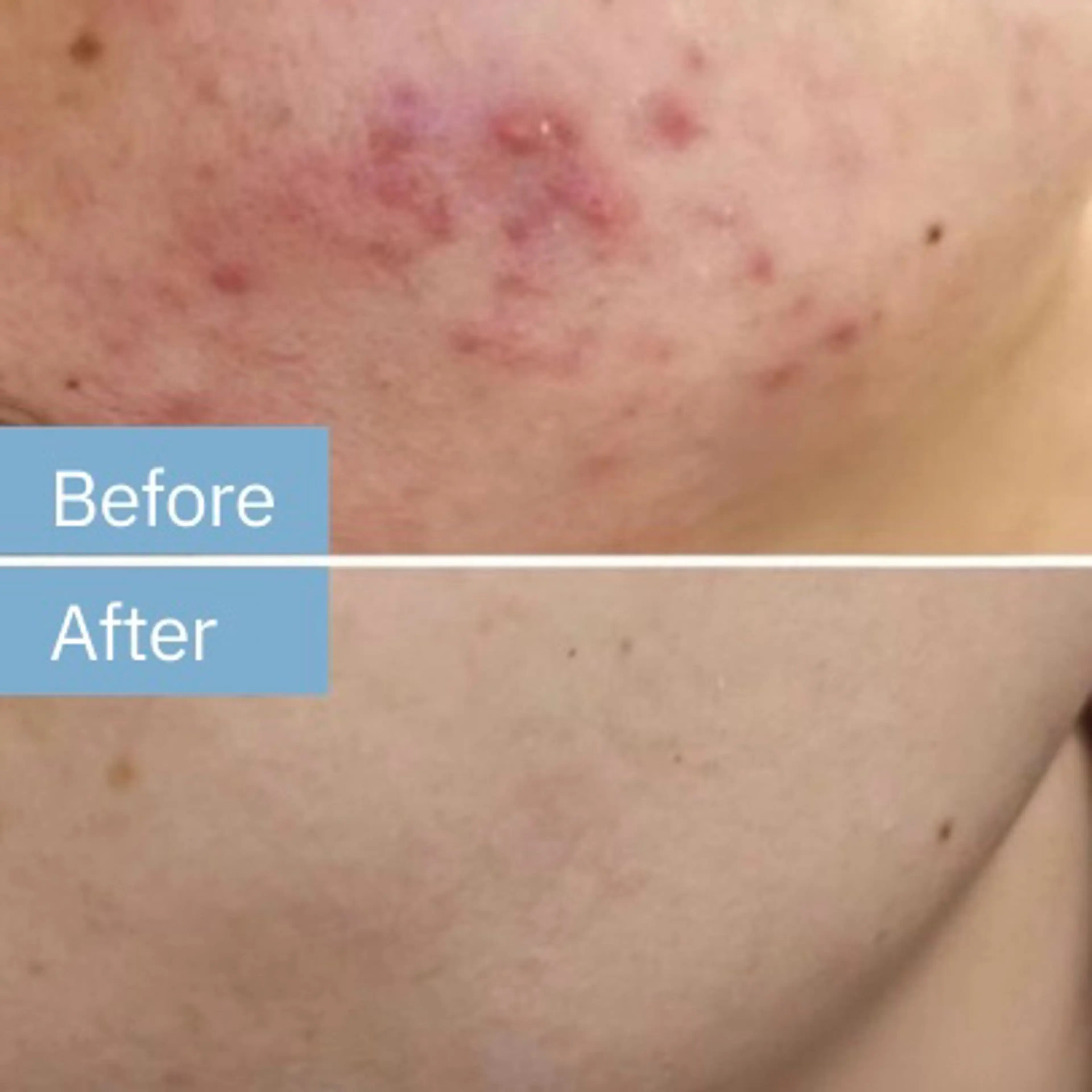 人気NO1 肌再生HAAB REPROハーブピーリングの写真