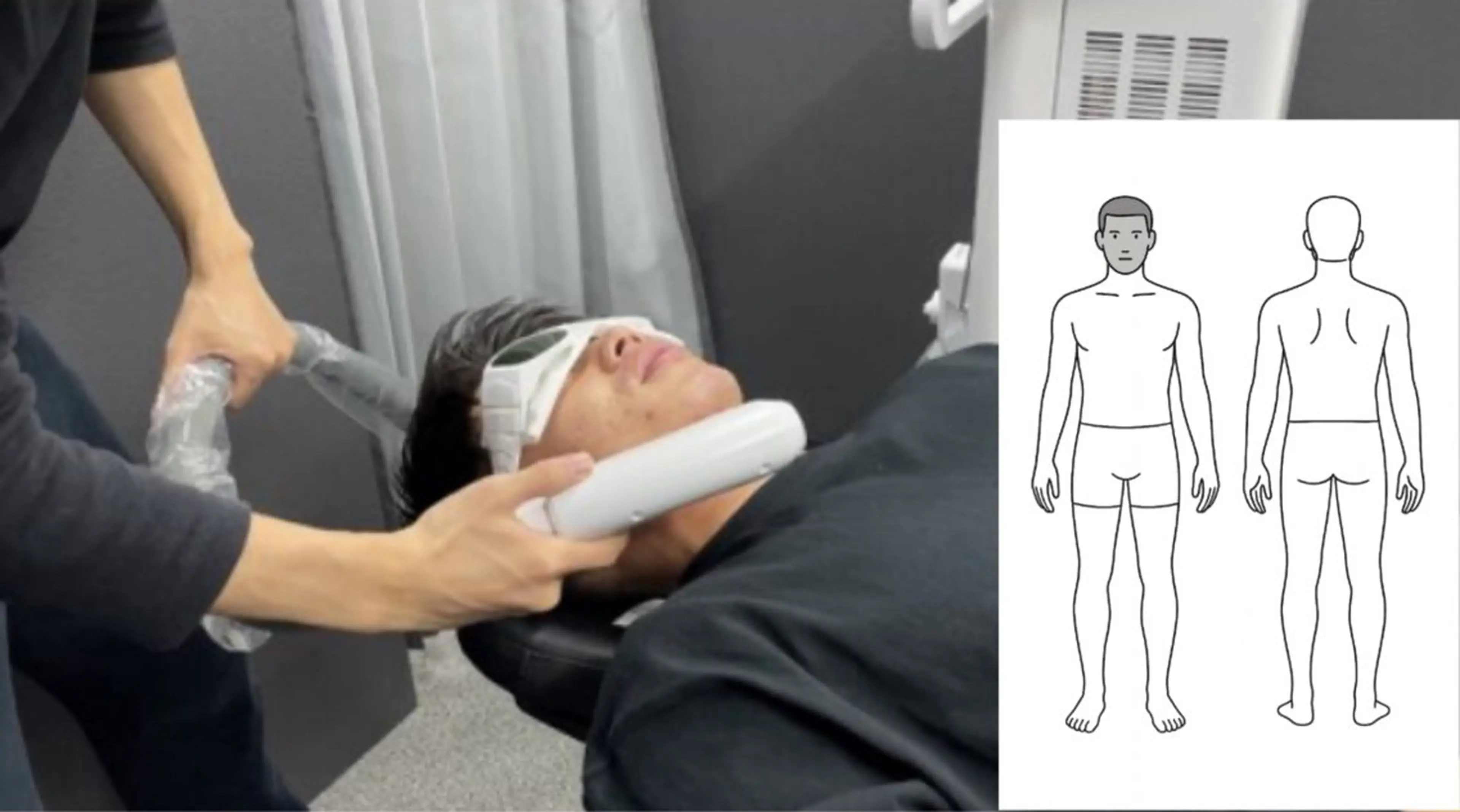 顔脱毛 通常3,000円→予約の方永久2,000円の写真