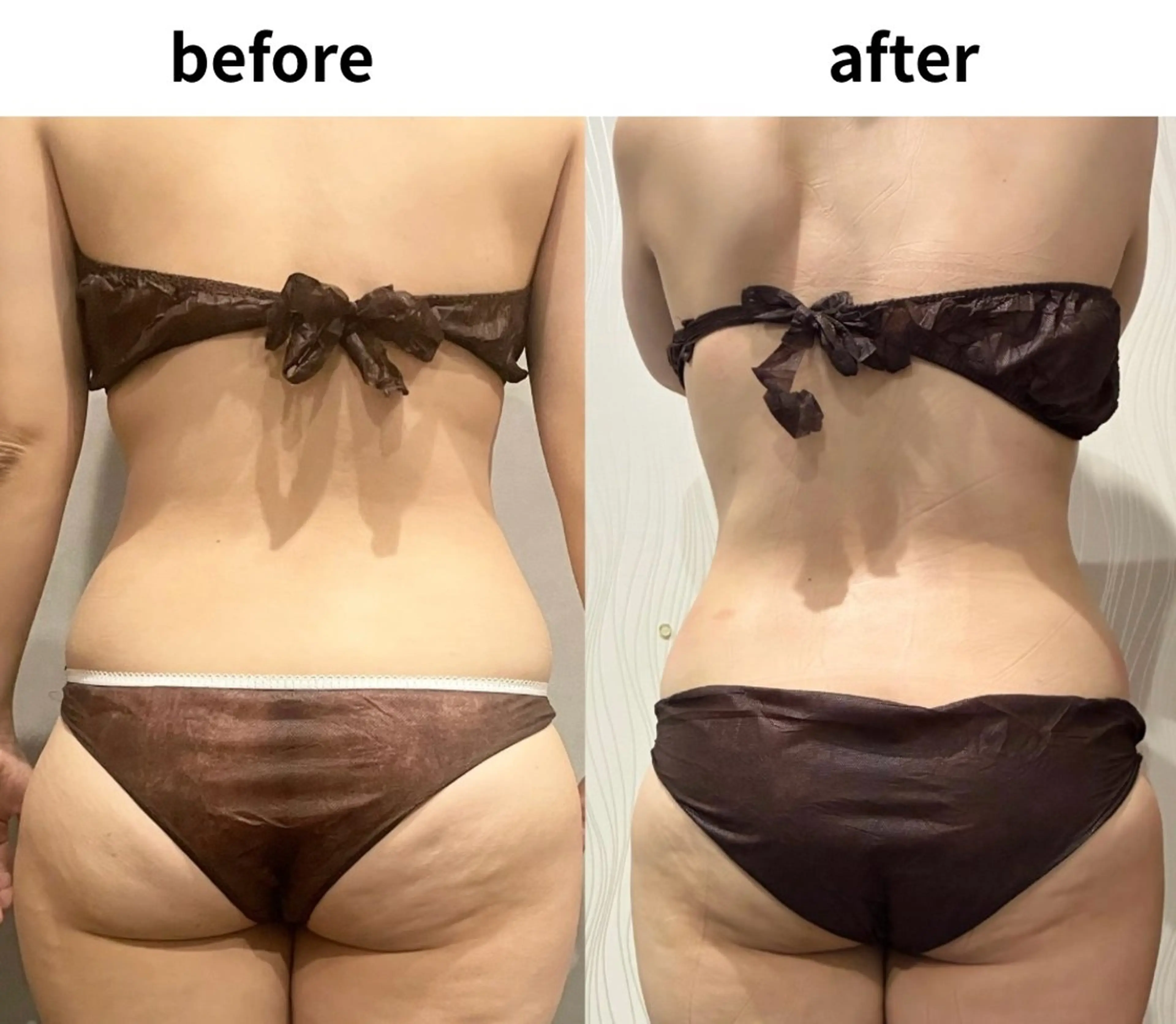 通常−50%off★【上半身or下半身】キャビテーション×温め×EMSで食べすぎリセット!90分コースの写真