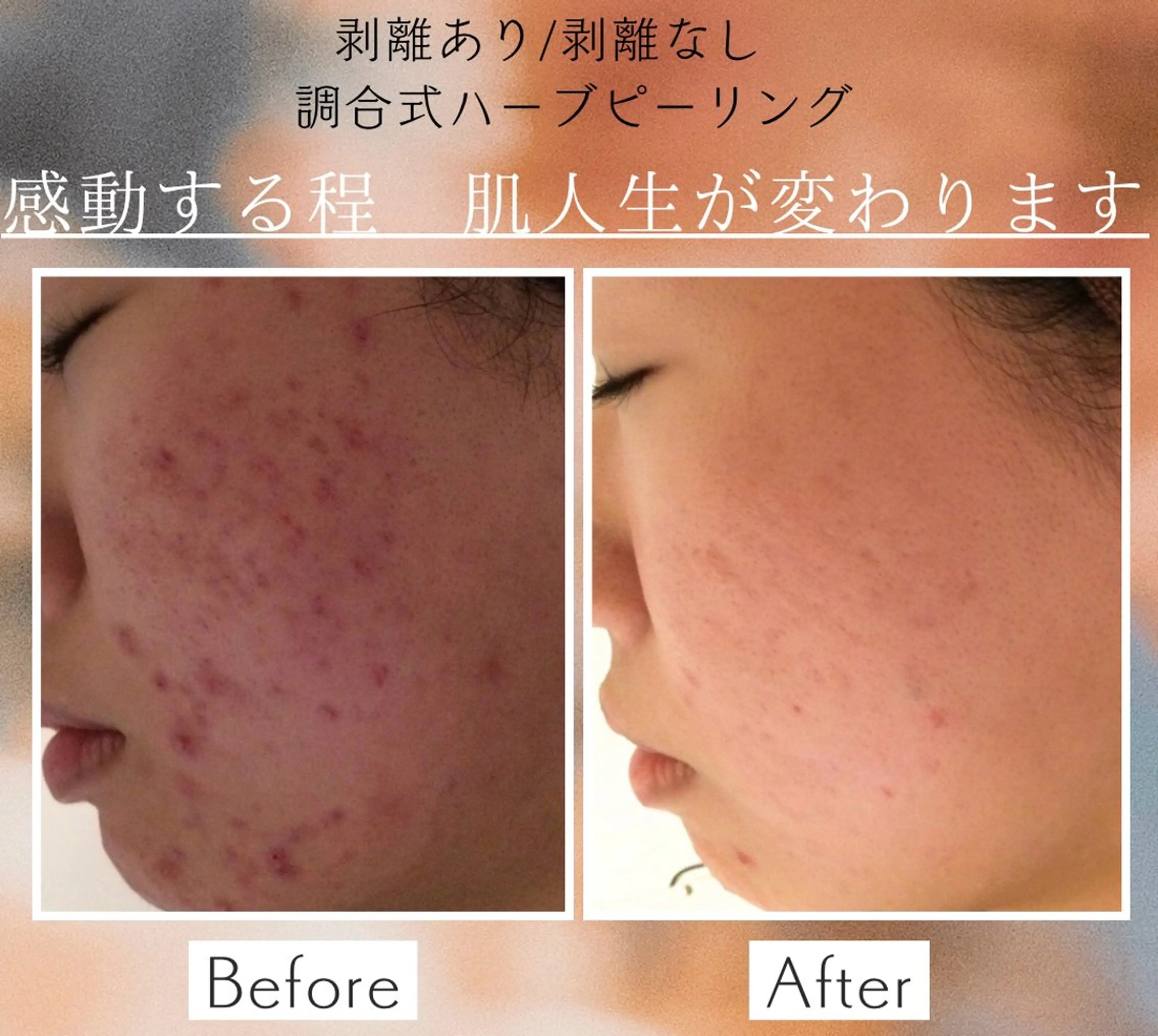 ニキビ/肌質改善専門 Snow skinのエステ・リラクイメージ