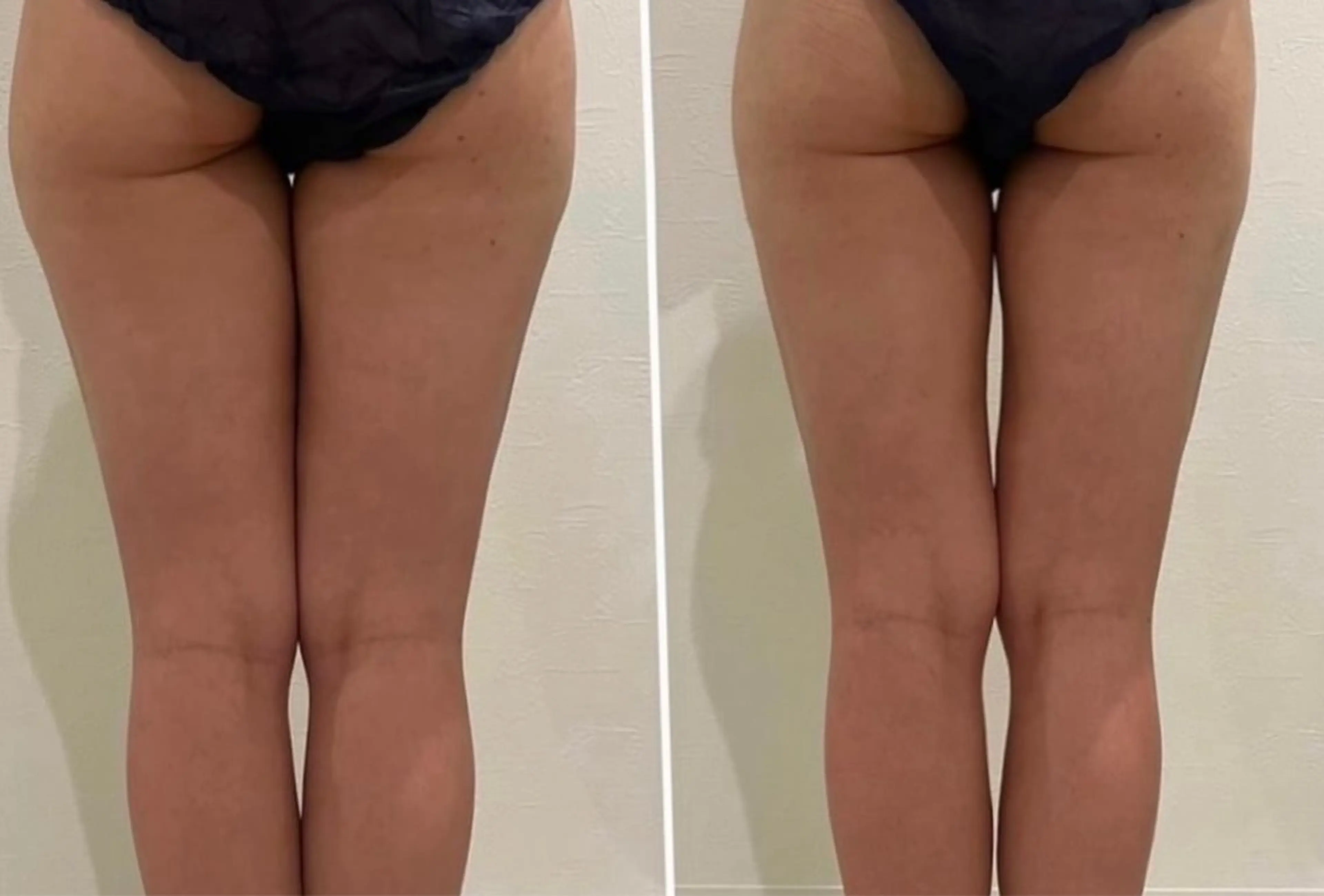 脚痩せ❣️痩身エステの写真