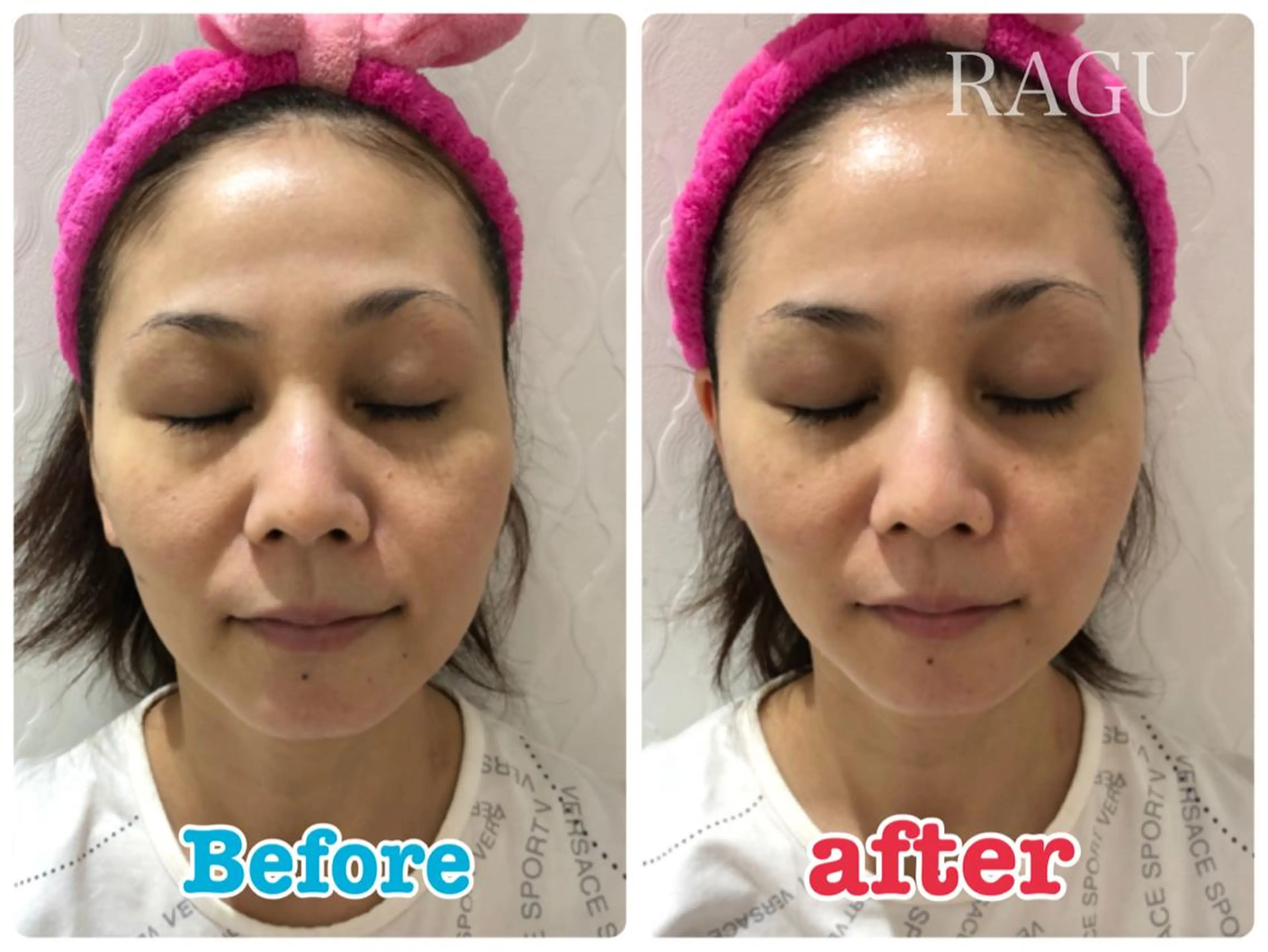 光フェイシャル初回の写真