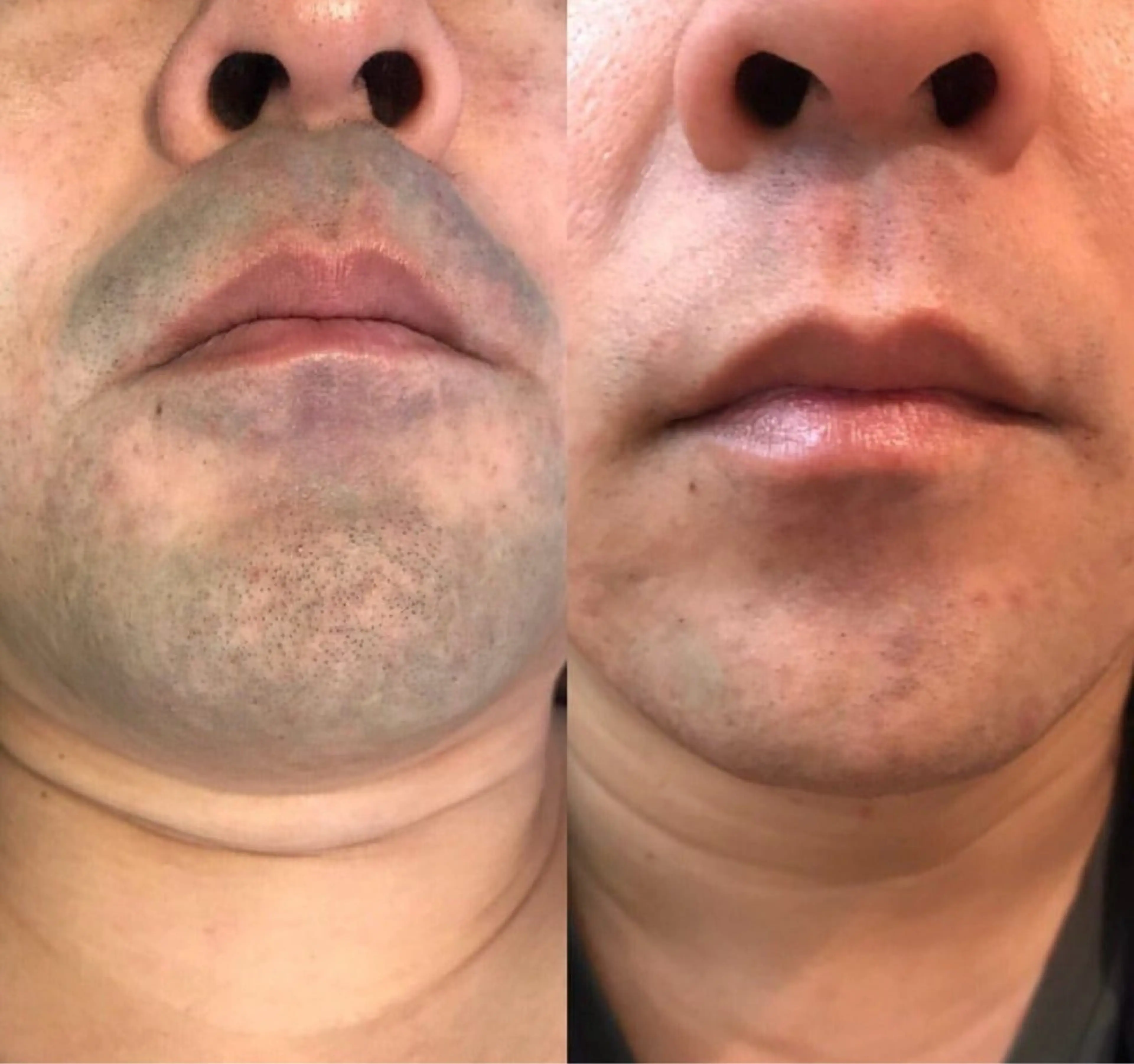 メンズ 脱毛 茶谷 梨紗のエステ・リラクイメージ