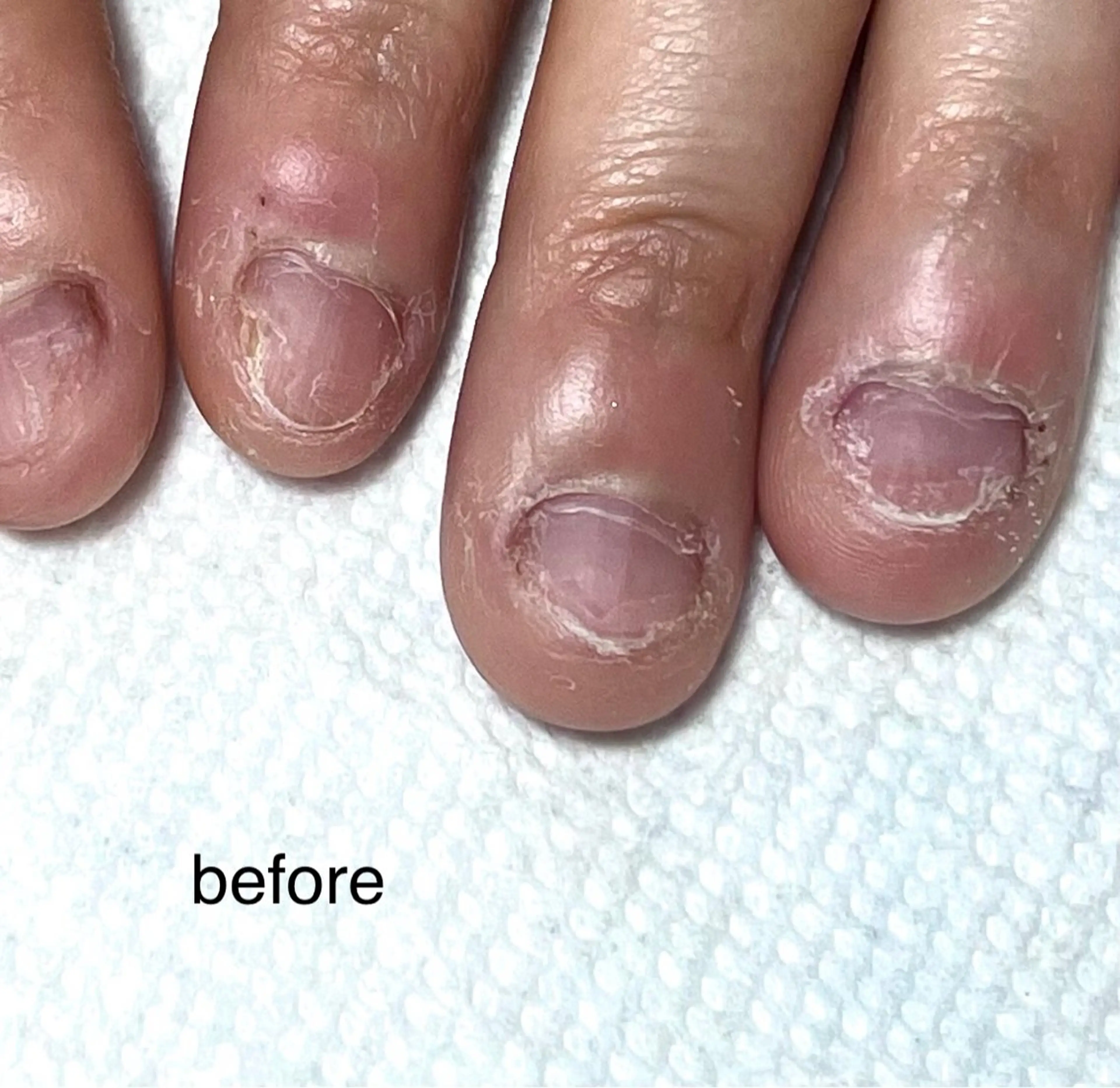 クリアジェル⭐︎自爪育成【深爪】【チビ爪】【たてすじ】【凸凹】の写真