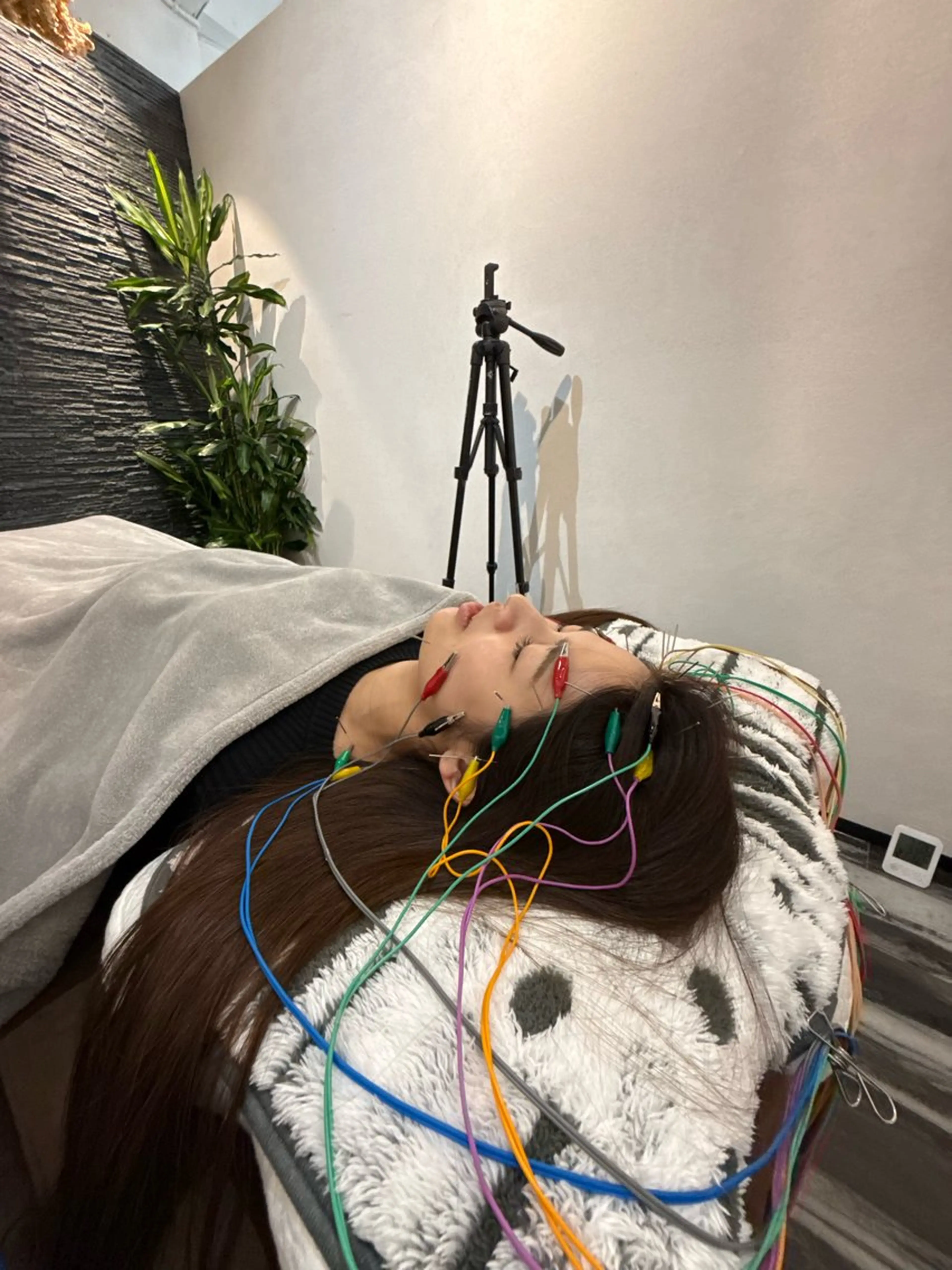 【ボトックス効き過ぎ対処美容鍼】まぶたが重い/目が開かない/違和感がある/口角が上がらない/左右差があるの写真
